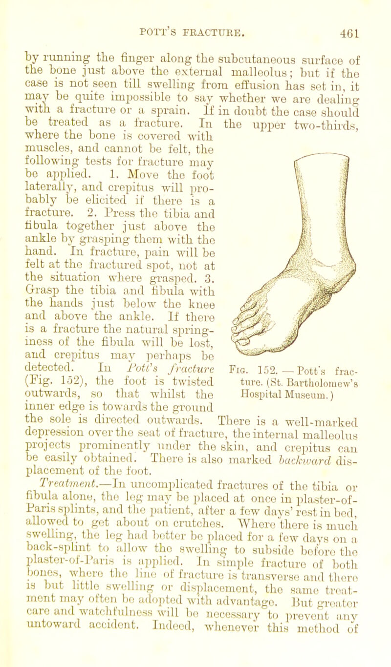 pott's fracture. running the finger along the subcutaneous surface of the bone just above the external malleolus; but if the case is not seen till swelling from effusion has set in, it may be quite impossible to say whether we are dealing with a fracture or a sjjrain. If in doubt the case should be treated as a fracture. In the upper two-thirds, where the bone is covered with muscles, and cannot bo felt, the following tests for fracture may be applied. 1. Move the foot laterally, and crepitus will pro- bablj' be elicited if there is a fractiu-e. 2. Press the tibia and fibula together just above the ankle by grasping them with the hand. In fracture, pain will be felt at the fractured spot, not at the situation where grasped. 3. Grasp the tibia and fibula with the hands just below the knee and above the ankle. If there is a fracture the natural spring- iness of the fibula will be lost, and crepitus may perhaps be detected. In Fotl's fracture Fio. 152.—Pott's frac- (Fig. 1.j2), the foot is twisted ture. (St. Bartholomew's outwards, so that whilst the Hospital Museum.) inner edge is towards the ground the sole is directed outwards. There is a well-marked depression over the seat of fracture, the internal malleolus projects prominently under the skin, and crepitus can be easily obtained. There is also marked backward cUs- placement of the foot. Treatment.—In uncomplicated fractures of the tibia or fibula alone, the log may be placed at once in plaster-of- Paris splints, and the patient, after a few days' rest in bod, allowed to get about on crutches. Where there is mucll swellmg,_ the log had bettor bo placed for a few days on a back-splmt to allow the swelling to subside before the plastor-of-Paris i.s applied. In simple fracture of both bones, where the line of fracture is transverse and thorn is but little swelling or displacement, the same treat- ment 7nay often 1h! adopted with advantage. ]3ut greater care and watchfulness will bo noce.s.sary to prevent any untoward accident. Indeed, whenever this metliod of