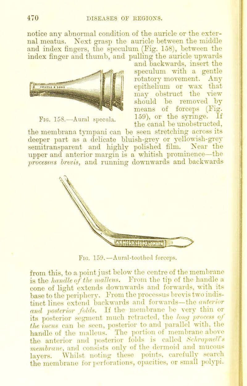 notice any abnormal condition of tlie auricle or the exter- nal meatus. Next grasp the amicle between the middle and index fingers, the speculum (Fig. 158), between the index finger and thtmab, and pulling the amicle upwards and backwards, insert the speculum with a gentle rotatory movement. Any epitheliiun or wax that may obstruct the view should be removed by means of forcej^s (Fig- 159), or the sjTinge. If the canal be unobstructed, the membrana tjoni^ani can be seen stretching across its deeper part as a delicate bluish-grey or yellowish-grey semitransparent and highlj^ polished film. Near the upper and anterior margin is a whitish prominence—the procesnus brtvis, and running downwards and backwards Fifi. ITiO.—Aural-tootlicd forceps. from this, to a point just below the centre of the membivme i.s the handle of the malleus. From the tip of th(^ handle a cone of light extends downwards and forwards, with its base to the periphery. From the processus brcvis two indis- tinct lines extend backwards and forwards—the anterior and posterior folds. If the membrane lie very thin or its posterior segment much retracted, the long process of the incus can be seen, posterior to and ]iarallel -n-ith. the hancUo of the malleus. The portion of membrane above the anterior and posterior folds is called Schrapneirs memhrane, and consists only of the dermoid and mucous layers. Whilst noting these points, carefully search the membrane for ]ierforations, opacities, or .small polypi. Fig. 158.—Aural specula.