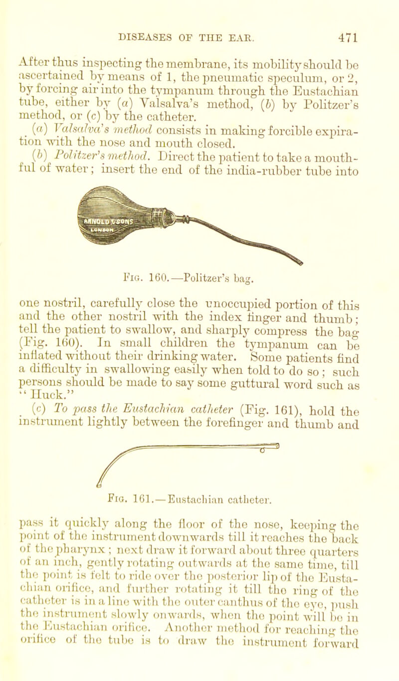 After thus inspecting the membrane, its mobility shoixhl be ascertained by means of 1, the pneumatic speculum, or 2, by forcing air into the tympanum through the Eustachian tube, either by (a) Valsalva's method, (6) by Politzer's method, or (c) by the catheter. _ (ff) Vahaha's method consists in making forcible expira- tion with the nose and mouth closed. [h) ^ Politzer's method. Direct the patient to take a mouth- ful of water; insert the end of the india-rubber tube into Fig. 160.—Politzer's bag. one nostril, carefully close the unoccupied portion of this and the other nostril with the index hnger and thumb; tell the patient to swallow, and sharply compress the bao- (Fig. IHO). In small children the tympaniun can be inflated without their drinking water. Some patients find a difficulty in swallowing easily when told to do so ; such persons should be made to say some guttm-al word such as  Iluck. (c) To jKtss the Eustachian catlieter (Fig. 161), hold the instrimient lightly between the forefinger and thumb and Fig. 161. — Eustacliian catheter. pass it quickly along the floor of the nose, keeping the point of the instrument downwards till it reaches the back of the pharynx ; next draw it forward about three quarters of an inch, gently rotating outwards at the same time, till the point is felt to ride over the posterior lip of the Eusta- chian orifice, and further rotating it till the ring of the catheter is in a lino with tlic outer canthus of tlio ej'o, push the instrument slowly onwards, when tlio point will bo in the iMistachian orihce. Another method for reaching the orifice of the tube is to ilriivv the instrument forward