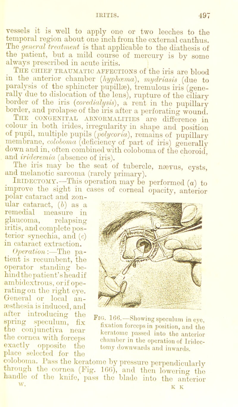 vessels it is_ well to apply oue or two leeches to the temporal region about one inch from the external canthus. The (jencral treatment is that applicable to the diathesis of the patient, but a mild course of mercmy is by some always prescriljed in acute iritis. The chief traumatic .^jtectioiv^s of the iris are blood in the anterior chamber {liyplmma), mydriasis (due to paralysis of the sphincter pupillfe), tremulous iiis (gene- rally due to dislocation of the lens), ruptm-e of the ciliary border of the iris {coredialysis), a rent in the pupillary border, and prolapse of the iris after a perforating wound. The _ congenital abnoejlveities are difference in coloiu- in both iiides, irregularity in shape and position of pupil, multiple pupils (polycoria), remains of pupillary membrane, eoloboma (deficiency of part of iris) generally down and in, often combined with eoloboma of the choroid, and irideremiu (absence of iris). The iris may be the seat of tubercle, nasvus, cysts, and melanotic sarcoma (rarely primary). iRiDECTOJir.—This operation may be performed (a) to improve the sight in cases of corneal opacity, anterior polar cataract and zon- ular cataract, [h) as a remedial measure in glaucoma, relapsing iritis, and complete pos- terior synechia, and (c) in cataract extraction. Operation :—The pa- tient is recumbent, the operator standing be- hind the patient's head if ambidextrous, orif ope- rating on the light eye. Groiicral or local an- aasthosia is induced, and after introducing the spring speculum, fix the conjunctiva near the cornea witli Forceps exactly op]H)sit() the place sol(!cted for the coloboiiui. I'iis.s the keratomo by pressure per])endicularly throiigli tlio cornea (Fig. IfUi), and then lowering the handle of tlie knife, pas.s the bliulo into the ant(aior Fk;. —Sliowing spcculmii in eye, fixation forceps in position, and tlic kenitonie passed into tlic antorioi- clianilier in tlio operation of Iridec- tomy downwards and inwards.