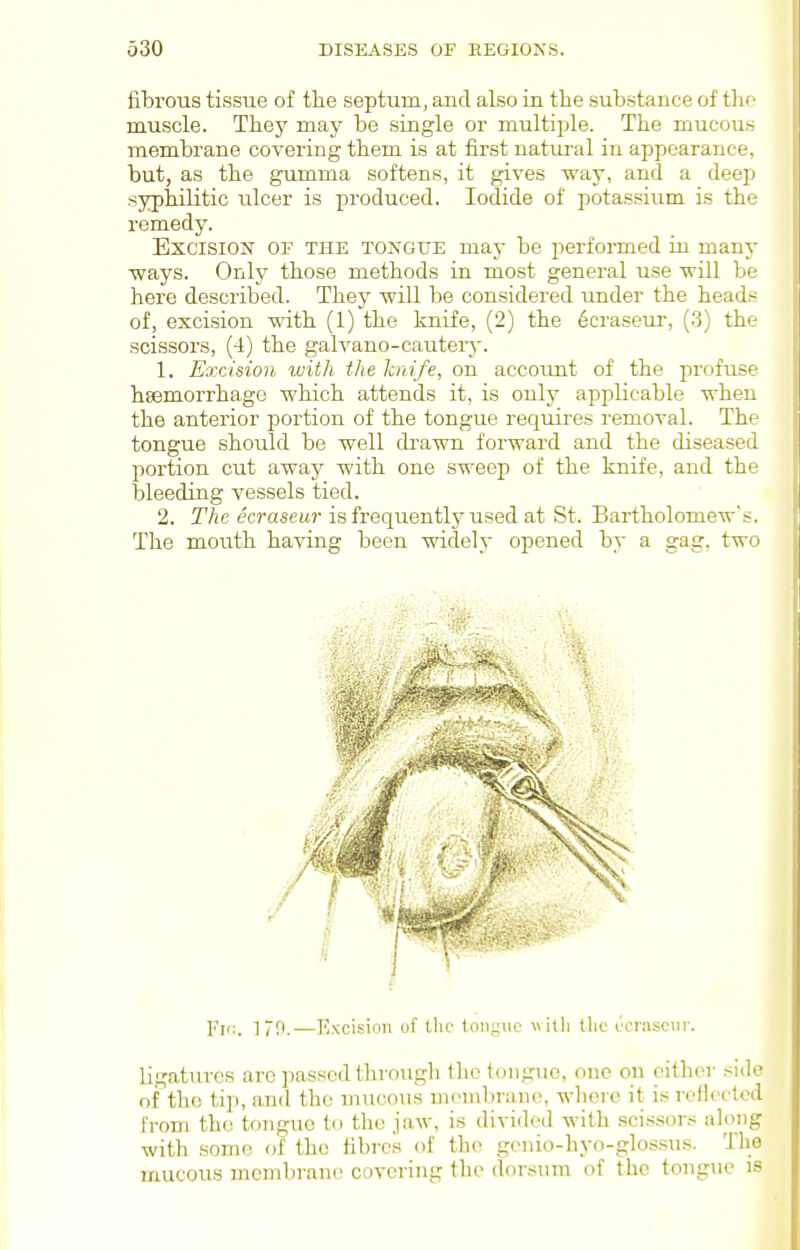 fibrous tissue of tlie septum, and also in the substance of thc' muscle. They may be .single or multiple. The mucou.s membrane covering them is at first natural in appearance, but, as the gumma softens, it gives way, and a deep syphilitic ulcer is produced. Iodide of potas.sium is the remedy. Excision of the tongue may be performed in many ways. Only those methods in most general use will be here described. They will be considered under the heads of, excision -wdth (1) the knife, (2) the 6craseur, (3) the scissors, (4) the galvano-cautery. 1. Excision with the hiife, on accoimt of the profuse haemorrhage which attends it, is only applicable when the anterior portion of the tongue requires removal. The tongue should be well di'awn forward and the diseased portion cut away with one sweep of the knife, and the bleeding vessels tied. 2. The ecraseur is frequently used at St. Bartholomew's. The mouth having been widely opened by a gag. two I'lr.. ]7P.—Excision of the tongue willi the ccriiscur. ligatures arc passed through the tongue, one ou cither side of the tip, and the mucous membrane, where it is reflected from the tongue to the jaw, is divided with .sci.>^sor.< along with some of the fibres of the genio-hyo-glossus. Tlie mucous membrane covering the dorsum of the tongue is