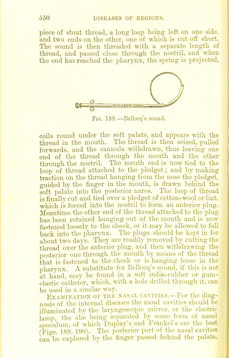 piece of stout thread, a long loop being left on one side, and two ends on the other, one of -which is cut off short. The sound is then threaded with a separate length of thread, and passed close through the nostril, and when the end has reached the pharynx, the spring is projected, Fig. 188.—Bellocq's sound. ' coils round under the soft palate, and appears with the thread in the mouth. The thread is then seized, pulled forwards, and the cannula withdrawn, thus leaving one end of the thi'ead through the mouth and the other through the nostril. The mouth end is now tied to the loop of thread attached to the pledget; and by making traction on the thread hanging from the nose the pledget, guided by the finger in the mouth, is drawn behind the soft palate into the posterior nares. The loop of thread is finally cut and tied over a pledget of cotton-wool or lint, which is forced into the nostril to form an anterior plug. Meantime the other end of the thread attached to the plug has been retained hanging out of the mouth and is now fastened loosely to the cheek, or it may be allowed to fall back into the pharynx. The plugs should be kept in for about two days. They are readily removed by cutting the thread over the anterior plug, and then withdrawing the posterior one through the mouth by means of the thread that is fastened to the cheek or is hanging loose in the pharynx. A substitute for Bellocq's sound, if this is not at hand, may be found in a soft india-rubber or gum- elastic catheter, which, with a hole drilled through it, can bo used in a similar way. Examination of tiii; nasal cavities.—For the diag- nosis of the internal diseases the nasal cavities should be illuminated by the laryngosco])ic mirror, or the electric lamp, the aide lieing sei)arated by some form of nasal speculum, of which Duplay's and Frankors are the best (Figs. IH'J, 100). The i)Osterior part of the na.sal cavities can bo explored by the finger passed behind the palate,