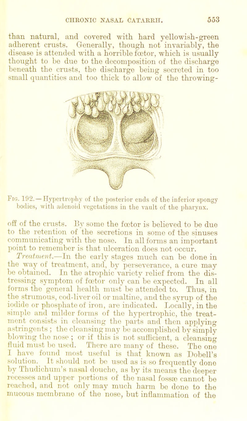 than natural, and covered with hard yellowish-green adherent crusts. Generallj', though not invariably, the disease is attended with a horrible footer, which is usually thought to be due to the decomposition of the discharge beneath the crusts, the discharge being secreted in too small quantities and too thick to allow of the throwing- Fir.. 192. — Hypcrtropliy of tlie posterior eucLs of the inferior spongy hodie-s, with adenoid vegetations in the vault of the pharynx. off of the crusts. By some the foetor is believed to be due to the retention of the secretions in some of the sinuses communicating ^ith the nose. In all forms an important point to remember is that ulceration does not occur. Treatment.—In the early stages much can be done in the way of treatment, and, by perseverance, a cure may bo obtained. In the atrophic variety relief from the dis- tressing symptom of foetor only can be expected. In all foi-ms the general health nuist be attended to. Thus, in the strumous, cod-liver oil or maltinc, and the syrup of the iodide or phosphate of iron, are indicated. Ijocally, in the simple and milder forms of the hypertrophic, the treat- ment consists in cleansing the parts and then applying astringents ; the clciinsiug may be accomiilished by simply blowing the nose ; or if this is not sufficient, a cleansing fluid must bo used. Th(!re arc many of these. The one I have found most usofail is that known as Dobell's solution. It should not be used as is so frequently done by Thudichum's na.sal douche, as by its means the deeper recesses and upper portions of the nasal J'ossai cannot be reached, and not only may much harm be done to the mucous membrane (;f tlio nose, but inllammation of the