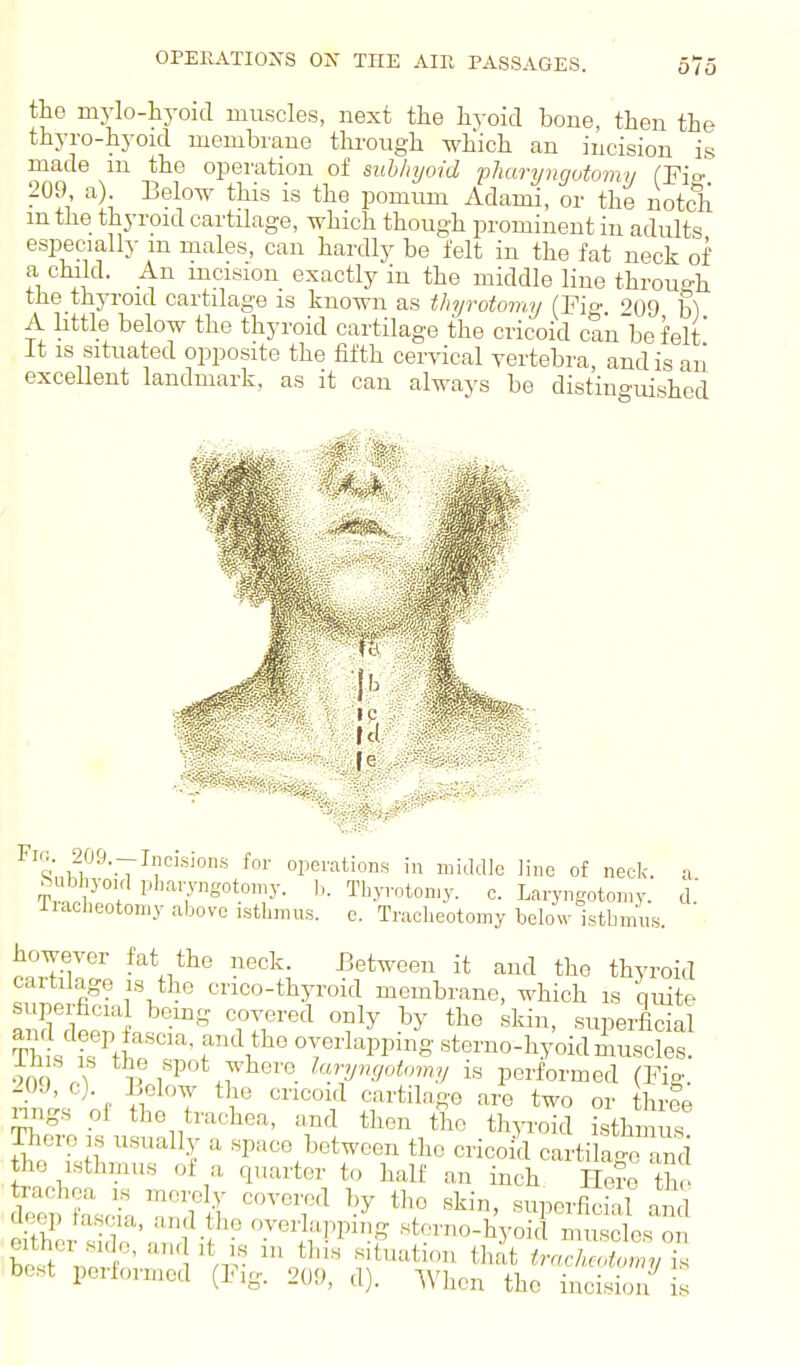 the mylo-hyoid muscles, next the liyoid bone, then the thyro-hyoicl membrane through which an incision is made m the operation of subhyoid pliarijngotumij (Fio-' 209 a). Below this is the pomnm Adami, or the notch mthe thyroid cartilage, which though prominent in adults especially m males, can hardly be felt in the fat neck of a child. An incision exactly in the middle line throu-h the thyroid cartilage is known as thyrotomy (Pig 009 ^) A little below the thyroid cartilage the cricoid can'be felt It IS situated opposite the fifth cervical vertebra and is an excellent landmark, as it can always be distinguished ,-/^'^-.7^'='«wn.s for operations in middle line of neck, a hubhyoKl pharyngotomy. Thyrotomy. c. Laryngotoniy. d.' Tiaclieotomy above istlimns. c. Traclieotomy below isthmus. however fat the neck. Between it and the thyroid cartilage is the cnco-thyroid membrane, which is quite superfacial bemg covered only by the skin, superficial ms 'f overlapping sterno-hy'oid muscS! •)mr\ ,«Po* ?^l^ere laryngotumy is performed (Fig 20J, c). Lclow the cricoid cartilage are two or thrle nngs of the trachea, and then tlio thyroid isthmus There is usually a space between the cricoid cartilao-o ami lie isthmus of a quarter to half an inch He^e th ■ trachea is merely covered by the skin, superficiil and deep fascia, and the overlapping storno-hVoi^ i m Ls i best performed (Fig. 209, ,1). ^\'ben the incision is