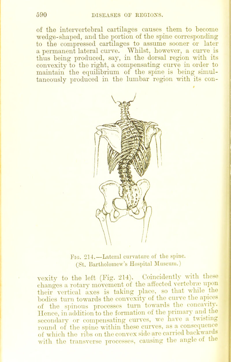 of the intervertebral cartilages causes them to become wedge-shaped, and the portion of the spine conresponding to the compressed cartilages to assume sooner or later a permanent lateral curve. Whilst, however, a curve is thus being produced, say, in the dorsal region with its convexity to the right, a compensating curve in order to maintain the equilibrium of the spine is being simul- taneously produced in the lumbar region with its con- Fir,. 214.—Liitcral curvatLirc of the spine. (St. Ijiirllioloincw's Ilospit.il ]\Iuseuiii.) voxity to the left (Fig. 214). Coincidently with tlicso changes a rotary movement of the affected vertobny u]iou their vortical axes is taking place, so that while the b()di(3S turn towards the convexity of the curve the apices of the s]iinoiis processes turn towards the concavity, llonci!, in addition to the formation of the primary and the secondary or comjiensating curves, wc have a tA\isting round of the spine within these curves, as a consequence of wliich the ribs on the cimvox side are earned backwards with the transverse processes, causing the angle of the