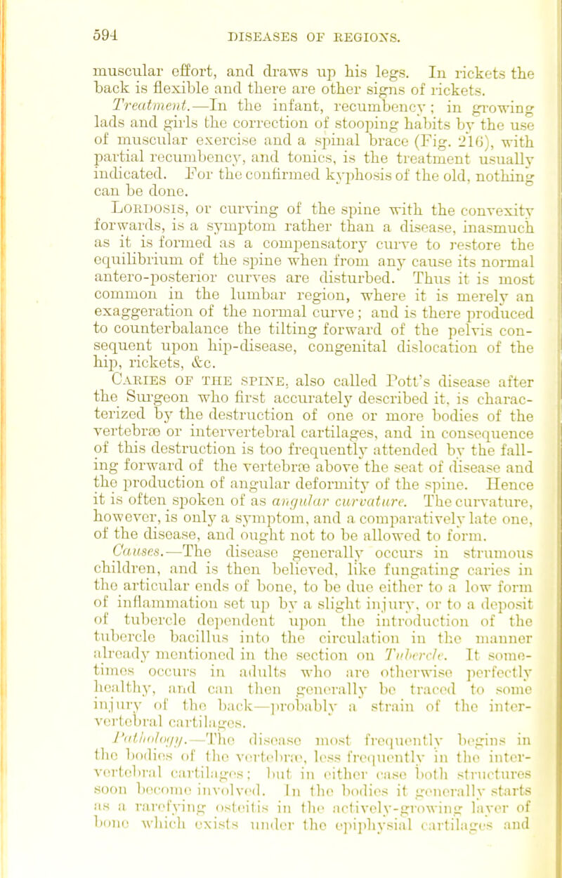 muscular effort, and draws up his legs. In rickets the hack is flexible and there are other signs of rickets. Treatment.—In the infant, recumbency ; in growing lads and girls the correction of stooping habits by the use of muscular exercise and a spinal brace (Fig. 'ilH), with partial recumbency, and tonics, is the treatment usually indicated. Por the confirmed kyphosis of the old, nothing can be done. LoKDOSis, or curving of the spine with the convexity forwards, is a symptom rather than a disease, inasmuch as it is formed as a compensatory curve to restore the equilibrium of the spine when from any cause its normal antero-pcsterior curves are disturbed. Thus it is most common in the lumbar region, where it is merely an exaggeration of the normal curve; and is there produced to counterbalance the tilting forward of the pelvis con- sequent upon hip-disease, congenital dislocation of the hi]), rickets, &c. Caries oe the spine, also called Tott's disease after the Sui'geon who first accurately described it, is charac- terized by the destruction of one or more bodies of the vertebras or intervertebral cartilages, and in conseqiience of this destruction is too frequently attended by the fall- ing forward of the vertebrre above the seat of disease and the production of angular deformity of the spine. Hence it is often spoken of as angutar curvature. The curvature, however, is only a symptom, and a comparatively late one, of the disease, and ought not to be allowed to form. Causes.—The disease generally occurs in stnunoTis children, and is then believed, like fungating caries in tho_ articular ends of bone, to be due either to a low form of infiammatiou set up by a slight injury, or to a deposit of tubercle dejiendeut upon the introduction of the tubercle bacillus into the circulation in the manner already mentioned in the section on Ti'hrrclr. It some- times occurs in adults who are otherwise jierfectly healthy, and can then generally be traced to some injury f)f the back—])robably a strain of the inter- vertebral cartilages. I'aiiidloj/i/.—The disease most freinuMitly begins in the bodies of tlie vertebnr, less frequently in the inter- vertebral cartilages: but in either case i)oth structures soon become involved. In flic bodies it generally starts as a rarefying osteitis in the actively-growing layer of bone which exists under the e]iiphysial cartilages and