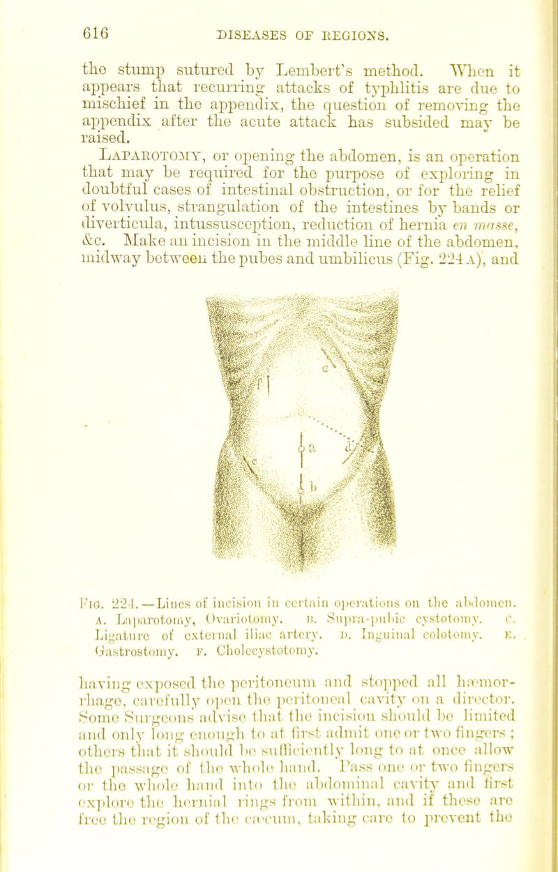 the stump sutured by Lembert's method. '^Mion it appears that reciuTing attacks of typhlitis are due to mischief in the appendix, the question of removing the appendix after the acute attack has subsided may be raised. LAPAROTOiiY, or oj^ening the abdomen, is an operation that may be required for the purpose of exploring in doubtful cases of intestinal obstruction, or for the relief of volvulus, strangulation of the intestines by bauds or diverticula, intussusception, reduction of hernia en masse, &c. Make an incision in the middle line of the abdomen, midway between the pubes and umbilicus (Fig. 224 a), and I'lO. 22-1.—Lines of incision in ceit^iin ojierations on tlic aliilonicn. A. Lii|)arotoniy, Dvariotoniy. )!. 8upni-iuiliic cystotomy. c. Liyalurc of c.xtoinal iliac artery, j). Inguinal colotoniy. k. yasti-ostoniy. v. Cholccystotoniy. having exposed tlio peritoneum and stopped all hivmor- rhagc, carefully o])en the poritonenl cavity on a director, t-'ome Surgeons advise that the incision should be limited and only long enough to at first admit one or two fingers ; others that it .should bo suHiciently long to at once allow the passage of the whole liiuid. I'ass one or two fingers or the whole hand into the abdominal cavity and first explore the hernial rings from within, and if these arc free the region of the ciecinn, taking care to prevent the