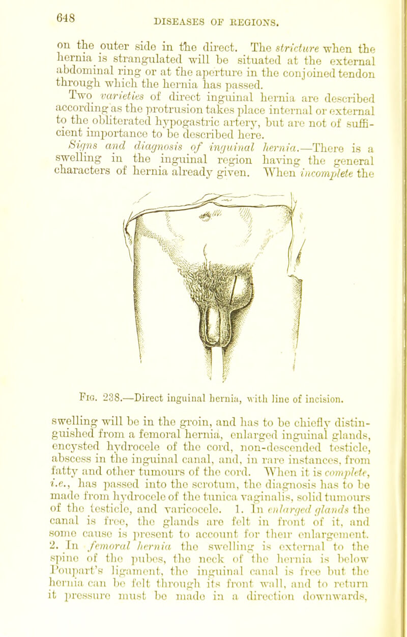 DISEASES OF REGIONS. on the outer side in tlie direct. The strktitre -when the hernia is strangukxted will be situated at the external abdominal ring or at the aperture in the conjoined tendon through which the hernia has passed. Two varieties of direct inguinal hernia are desciibed according as the protrusion takes place internal or external to the obhterated hj-pogastric artery, but arc not of suffi- cient importance to be described here. Sir/ns and diagnosis of inguinal hernia.—There is a swelling in the inguinal region having the general characters of hernia already given. When i/(co»i;jWe the Pig. 238.—Direct inguinal bernia, w ith line of incision. swelling will bo in the groin, and has to be chiefly distin- guished from a femoral hernia, enlarged inguinal glands, ency.sted hydrocele of the cord, non-descended testicle, abscess in the inguinal canal, and, in rare instances, from fatty and other tumours of the cord. When it is compldc, 1. e., has passed into the scrotum, the diagnosis has to bo made from hydrocele of the tunica vaginalis, solid tumours of the testicle, and varicocele. 1. In otlan/ed r/Iands tho canal is free, the glands are felt in front of it. and somo cause is present to account for their enlargement. 2. In femoral Jiernia tho swelling is external to the •spine of tho ])ubes, tho neck nl' llio liernia is below I'oupart's ligaincnt, tho inguiiiiil canal is free but tlie hernia, can bo felt tlirough its front wnll, and to return it pressure must bo made in a direction downwards.