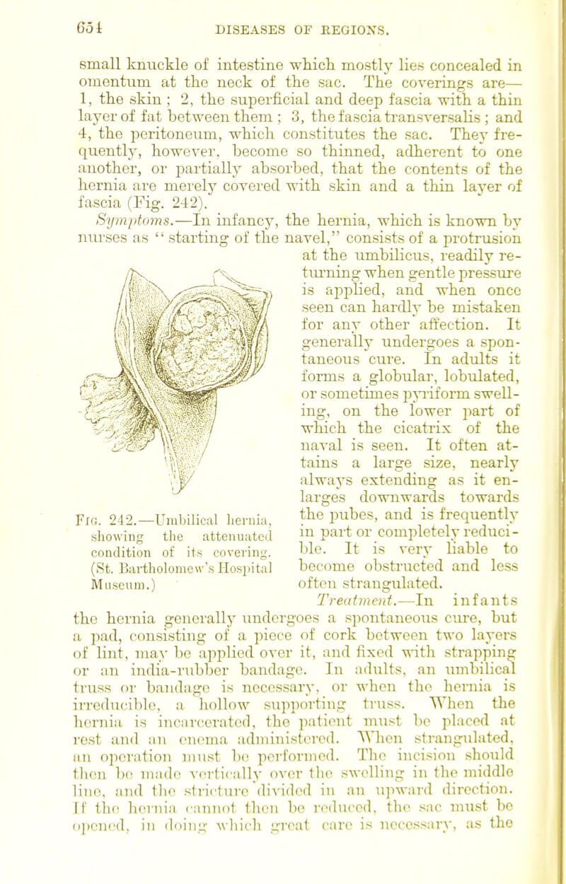 small knuckle of intestine wkicli mostly lies concealed in omentum at the neck of the sac. The coverings are— 1, the skin ; 2, the superficial and deep fascia vriih a thin laj^er of fat between them ; 3, the fascia transversalis ; and 4, the peritoneum, which constitutes the sac. They fre- quently, however, become so thinned, adherent to one another, or jjartially absorbed, that the contents of the hernia are merely covered with skin and a thin layer of fascia (Fig. 242). Symptoms.—In infancy, the hernia, which is known by niu'ses as  starting of the navel, consists of a protrusion at the umbilicus, I'eadily i-e- tiu'ning when gentle pressure is applied, and when once seen can hardly be mistaken for any other affection. It generally undergoes a spon- taneous cure. In adults it forms a globular, lobulated, or sometimes pyiiform swell- ing, on the lower part of which the cicatrix of the naval is seen. It often at- tains a large size, nearly always extending as it en- larges downwards towards the pubes, and is frequently in part or completely reduci- ble. It is verj' liable to become obstructed and less often strangulated. Treatment.—In infants the hernia geneiuUj- amdorgoes a spontaneous ciu-e, but a pad, consisting of a piece of cork between two layers of lint, may bo applied over it, and fixed with strapping or an india-rubber bandage. In adults, an innbilical truss or bandage is necessary, or when the hernia is irreducible, a hollow supporting truss. When the hernia is incarcerated, the patient must be placed at rest and an enema administered. When strangulated, an operation must b(! performed. The incision should then bo made vertically over tlie swelling in the middle line, and the slrictui-e divided in an upward direction. If the hernia cannot then be reduced, the .sac mu.st bo opened, in doing which great care is necessary, as the (St. Bartholomew's HospitrtI Museum.)