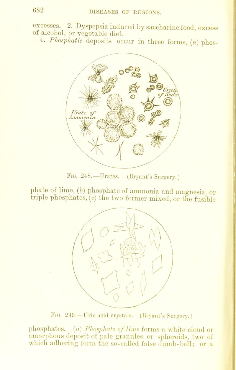 excesses. 2. D3'spepsia induced by saccharine food, excess oi alcohol, or vegetable diet. 4. Phosphatio deposits occur in three forms, (a) jjhos- FiG. 248.—Urates. (Bryaut'.s Surgery.) phate of lime, Qj) phosphate of ammonia and magnesia, or triple phosphates, (c) the two former mixed, or the fusible I'^'iii. ii'.).— Uric iicid cry.stiiLs. (IIryanl's Surgery.) phosphates. ((/) T'lio^phatc of lime forms a white cloud or iimorjdious (k'jiosit of ]ialc granules or .sjihcroid.s, Uxo of whicli adlicring form the so-called false dumb-hell; or a