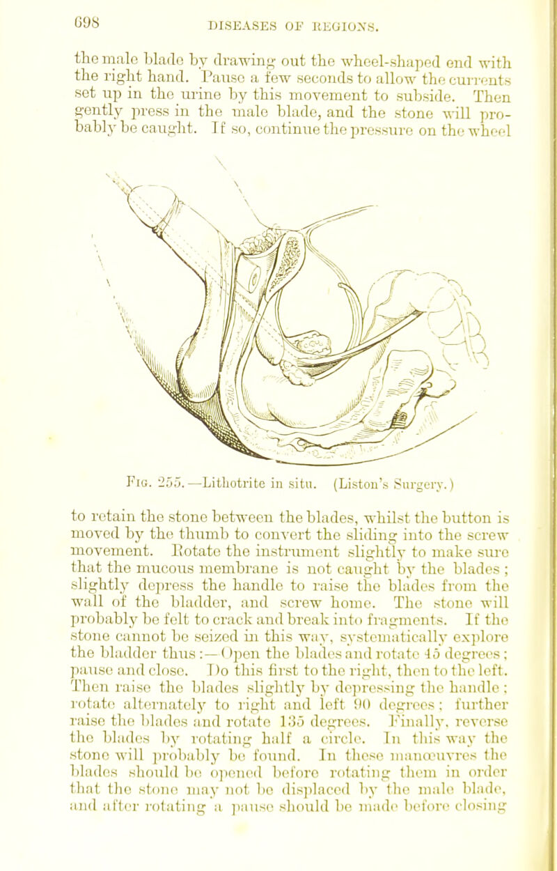 G9S the male blade by ilrawinj^- out tbe wheel-shaped end with the right hand. Pause a few secouds to allow the currcuts set up in the urine by this movement to subside. Then gently press in the male blade, and the stone will pro- bably be caught. If so, continue the pressure on the wheel \ Fig. 255.—Litliotrite in situ. (Listou's Surgery.) to retain the stone between the blades, whilst the button is moved by the thumb to convert the sliding into the screw movement. Eotate the instrimaent slightly to make sure that the mucous membrane is not caught by the blades ; slightly depress the handle to raise the blades from the wall of the bladder, and screw home. The stone will probably be felt to crack and break into fragments. If the stone cannot be seized iai this way, systematically explore the bhulder thus :— ()pen the blades and rotate 45 degrees; pause and close. Do this first to the right, then to the left. Then raise the blades slightly by depressing the handle : rotate alternatelj^ to right and left 90 degrees; further raise the blades and rotate loo degrees. I'lnally, rever.se the blades l)y rotating half a circle. Tn this way the .stone will jirobably be found. In these manoeuvres the blades should bo opened before rotating them in order that the stone may not bo disjdaced by the male blade, and after rotating a pause should be made before closing