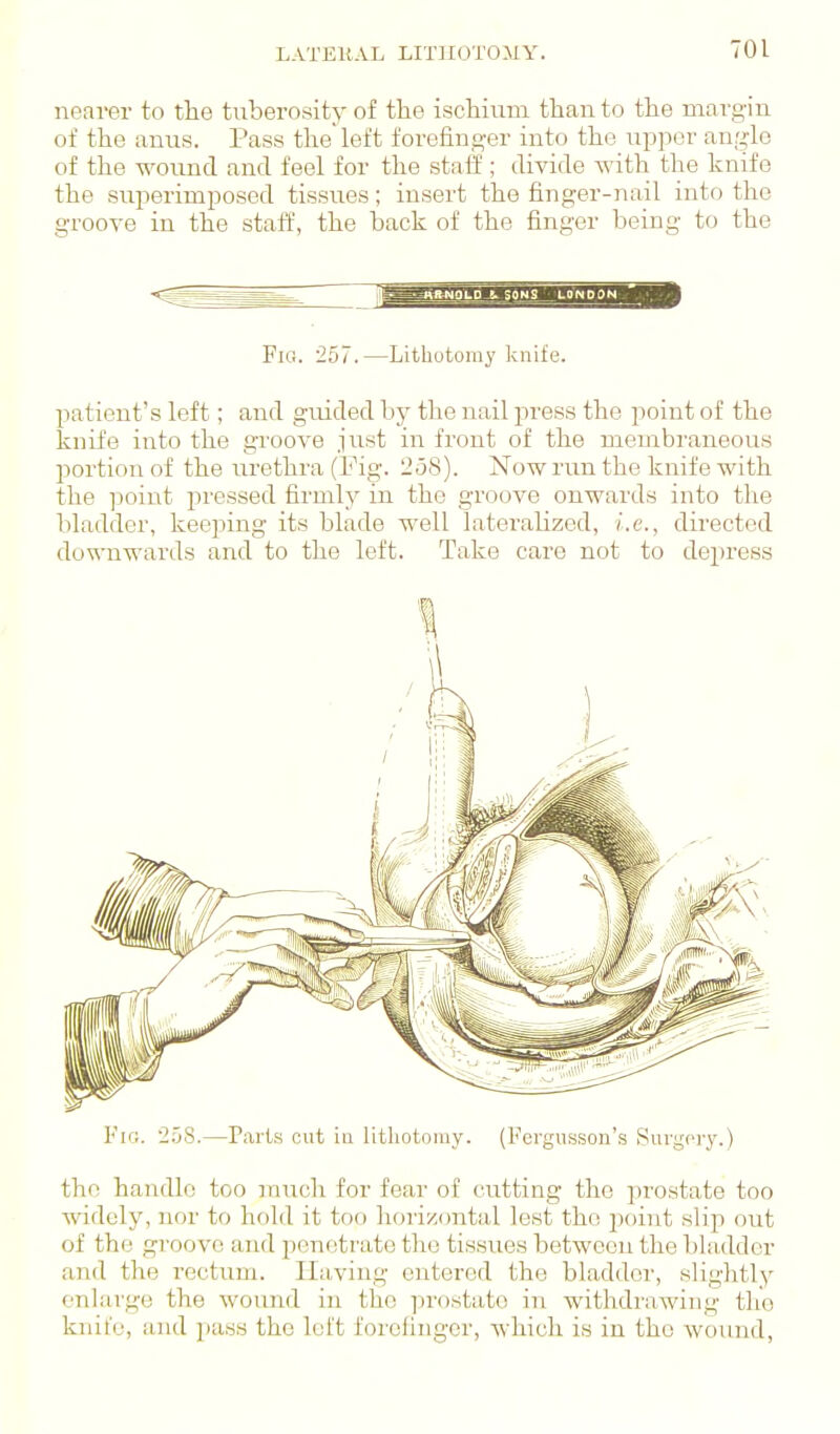 nearer to the tuberosity of the ischium than to the margin of the anus. Pass theleft forefino'er into the nppor angle of the wound and feel for the staff ; divide with the knife the superimposed tissues; insert the finger-nail into the groove in the staff, the back of the finger being to the Fig. 257.—Lithotomy knife. patient's left; and guided by the nail press the point of the knife into the groove just in front of the membraneous portion of the urethra (Fig. 2o8). Now run the knife with the ]5oint pressed firmly in the groove onwards into the bladder, keeping its blade well lateralized, i.e., directed downwards and to the left. Take care not to depress Fig. 2.58.—Parts cut iti litliotniuy. (Fergusson's Surgery.) the handle too much for fear of cutting the prostate too widely, nor to hold it too horizcmtal lest the point slip out of the groove and ponotrate the tissues between the bladder and the rectum. Having entered the bladder, slightly enlarge the wound in the prostate m withdrawing the knife, and pass the loft forclinger, Avhich is in the wound.