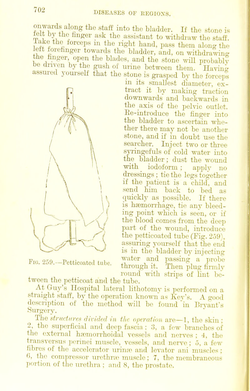 DISEASES OF REGIOXS. onwards along the staff into the blad.ler. If the stone is teit by the finder ask the assistant to withdraw the staff, lake the iorceps m the liglit hand, pass them along the leit forefinger towards the bladder, and, on withdraw-in- the hnger open the blades, and the stone will probably be driven by the gush of nrine between them. Havin- assured yourseK that the stone is grasped by the forcepl in its .smallest diameter, ex- tract it by making traction downwards and backwards in the axis of the pelvic outlet. Ee-introduce the finger into the bladder to ascertain whe- ther there may not be another stone, and if in doubt use the searcher. Inject two or thi-ee syi'ingefuls of cold water into the bladder; dust the wound with iodoform ; apply no dressings ; tie the legs together if the patient is a child, and send him back to bed as quickly as possible. If there is haemorrhage, tie any bleed- ing point whicii is seen, or if the blood comes from the deep part of the wound, inti'oduce the petticoated tube (Fig. 259}. Fig. 259.—Petticoated tube. assuring yourself that the end is in the bladder by injecting water and jiassing a probe through it. Then plug firmly round with strips of lint be- tween the petticoat and the tube. At Guy's Hospital lateral lithotomy is performed on a straight staff, by the operation known as Key's. A sood description of the method will bo found 'in Bryant's SurgC'ry. The sir net I (res cjiridvd in the operation are—1, the skin ; 2, the superficial and deep fascia : ;3, a few branches of the external hasmorrhoidal vessels and nerves ; 4, the traiisversus ])orinei muscle, vessels, and nerve; 5, a few fibres of tlic accelerator urinfp and levator ani muscles ; (), the com]u-cssor urethrie muscle; 7. the membraneous portion of the urethra ; and 8, the prostate.