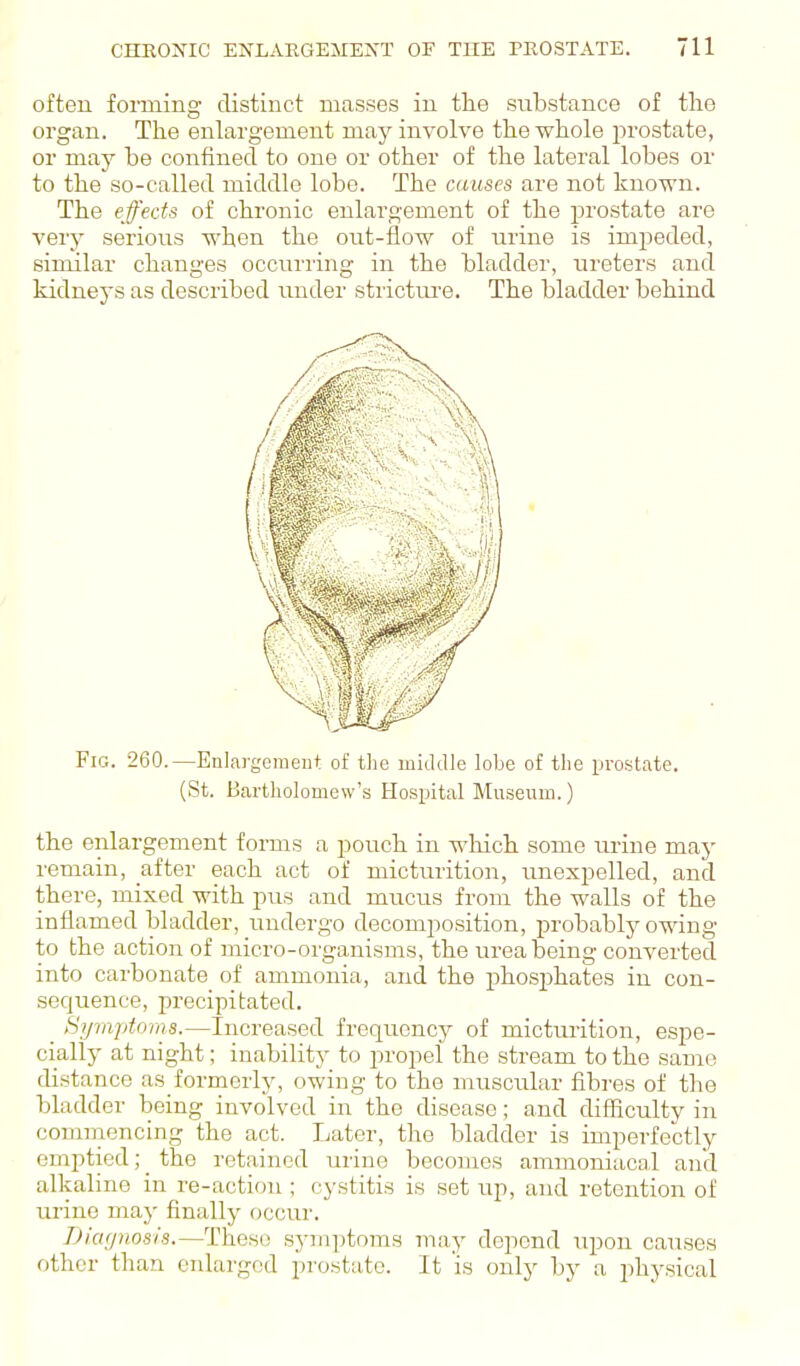 often forming distinct masses in tiie substance of the organ. The enlargement may involve the whole prostate, or may he confined to one or other of the lateral lobes or to the so-called middle lobe. The causes are not known. The effects of chronic enlargement of the prostate are very serioiis when the out-flow of urine is impeded, similar changes occurring in the bladder, ureters and kidneys as described under strictui'e. The bladder behind Fig. 260.—Enlargement of tlie middle lobe of the prostate. (St. Bartholomew's Hospital Museum.) the enlargement forms a pouch in which some urine may remain, after each act of micturition, unexpelled, and there, mixed with pus and mucus from the walls of the inflamed bladder, i^ndergo decomposition, probably owing to the action of micro-organisms, the urea being converted into carbonate of ammonia, and the phosj^hates in con- .sequence, precipitated. _ Hipajdoins.—Increased frequency of micturition, espe- cially at night; inability to propel the stream to the same distance as formerly, owing to the muscular fibres of the bladder being involved in the disease; and difficulty in cominencing the act. Later, the bladder is imperfectly emptied; _ the retained urine becomes ammoniacal and alkaline in re-action ; cystitis is set up, and retention of urine may finally occur. DuKjnosis.—These symptoms may depend upon cau,sea other than enlarged prostate. It 'is only by a physical