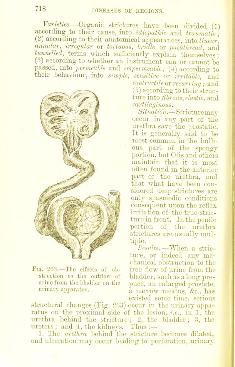 Varieties.—Ovganic strictures have been divided (1) according to their cause, into idiopathic and truumaiic ; (2) according to their anatomical appearances, into linear, annular, irregular or tortuous, Iridic or pacldhread, and tunnelled, terms which sufficiently explain themselves; (3) according to whether an instrument can or cannot be passed, into permeaUe and impermeuhle; (4) according to their behaviour, into simple, sensitive or irritable, lind contractile or recurring; and (o) according to their struc- tm-e into fibrous, elastic, and cartilaginous. Situation.—Stricture may occm- in any part of the urethra save the prostatic. It is generally said to be most common in the bulb- ov;s part of the spongy jjortion, but Otis and others maintain that it is most often found in the anterior 2)art of the urethra, and that what have been con- sidered deep strictiu-es are only sj^asmodic conditions consequent upon the reflex irritation of the true stric- tiu-e in front. In the penile portion of the urethra strictures are usually mul- tix)le. llesults. —'\^Tien a stric- ture, or indeed any me- chanical obstruction to the free Jlow of lu-ine from the bladder, such as a long pre- puce, an enlarged jn'ostatc, a narrow meatus, &c., has existed some time, serious structural changes (Fig. 263) occur in the luiuary ai)]ia- ratus on the jiroximal side of the lesion, i.e., in 1, the urethra behind the stricture; 2, the bladder; 3, the ureters; and -1, the kidneys. Thus:— 1. The urethra behind the stricture becomes dilated, and ulceration may occur leading to jierforation, ruinary Fio. 20.3.—The ell'ects of ol)- stniction to tlie outflow of urine from the bladder on the urinary apparatu.s.