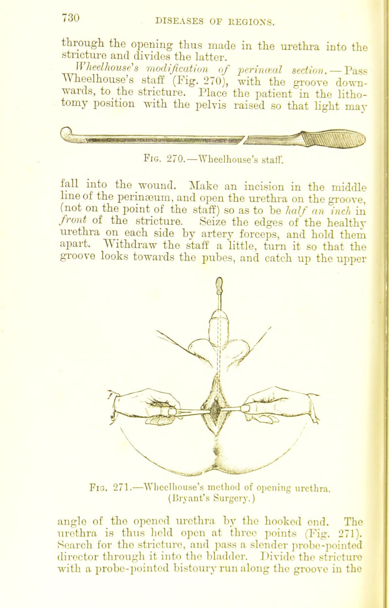 tlirougli the opening thus made in the urethra into the stricture and divides the latter. Wheelhouse's modification of perinaml section. — Pas^ Wheelhouse's staff (Fig. 270), with the groove down- wards, to the stricture. Place the patient in the litho- tomy position with the pelvis raised so that light mav Fig. 270.—Wheelhouse's .stall'. fall mto the wound. Make an inci.sion in the middle line of the perinaeum, and open the ui-ethi-a on the gi-oove, (not on the point of the staff) so as to be half an inch m front of the stricture. Seize the edges of' the healthv urethra on each side by artery forceps, and hold them apart. Withdraw the staff a little, turn it so that the groove looks towards the pubes, and catch up the upper Fio. 271.—Whcclhnuse'.s mctlind of opening nrcthra. (Dry,ant's Surgery.) angle of the ojienod urethra by the hooked end. The urethra is thus lield open at three points (Fig. 271). Search for the stricture, and ]ias.s a slender ]irobe-]iointed director througli it into the bladder. Divide the strictiu'e with a probe-pointed bistoury run along the groove in the