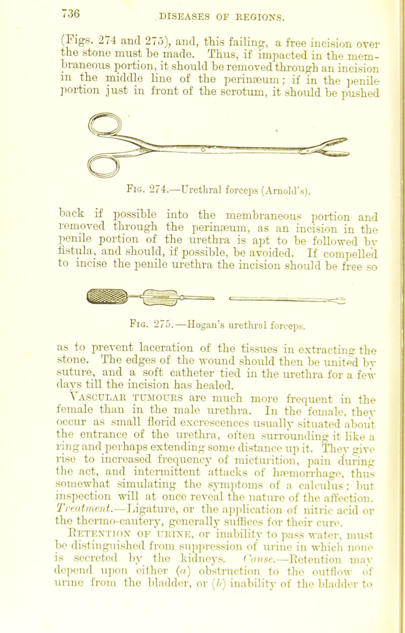 (Figs. 274 and 275), and, tliis failing, a free incision over the stone must be made. Thus, if impacted in the mem- braneous portion, it should be removed through an incision in the middle line of the perinfeum; if in the ]jenile ])ortion just in front of the scrotum, it should be pushed Fig. 274.—Uretliral forceps (Arnold's). back if possible into the membraneous portion and removed through the perinteum, as an incision in the ]ienile portion of the urethra is apt to be followed by fistula, and should, if possible, be avoided. If compelled to incise the penile urethra the incision should be free so Fig. 275.—Hogau's urethral forceps. as to prevent laceration of the tis.sues in extracting the stone. The edges of the wound should then be united by suture, and a soft catheter tied in the urethra for a few days till the incision has healed. Vascular TUjrouES are much more frequent in the female than in the male urethra. In the female, thev occur as small florid excrescences usually situated about the entrance of the lu-ethra, often surrounding it like a ring and perhaps extending some distance up it. They sive rise to increased frequency of micturition, pain during the act, and intermittent attacks of hjiemorrhaire. thus somewhat simulating the sym]itoms of a calcuhis; but inspection will at once reveal the nature of the affection. Tnmtment.—Ligature, or the apjdication of nitric acid or the thormo-catitery, generally suffices for their cure. Eetextiox of TTiiiXE, or inability to pass water, must be distinguished from su])i)ression of uj-ine in wliicli noin' is secreted by the Icidneys. Cause.—detention iiiny depend upon cither (a) obstruction to the outflow (if urmc from the bladder, or (/-) inability of the bladder to