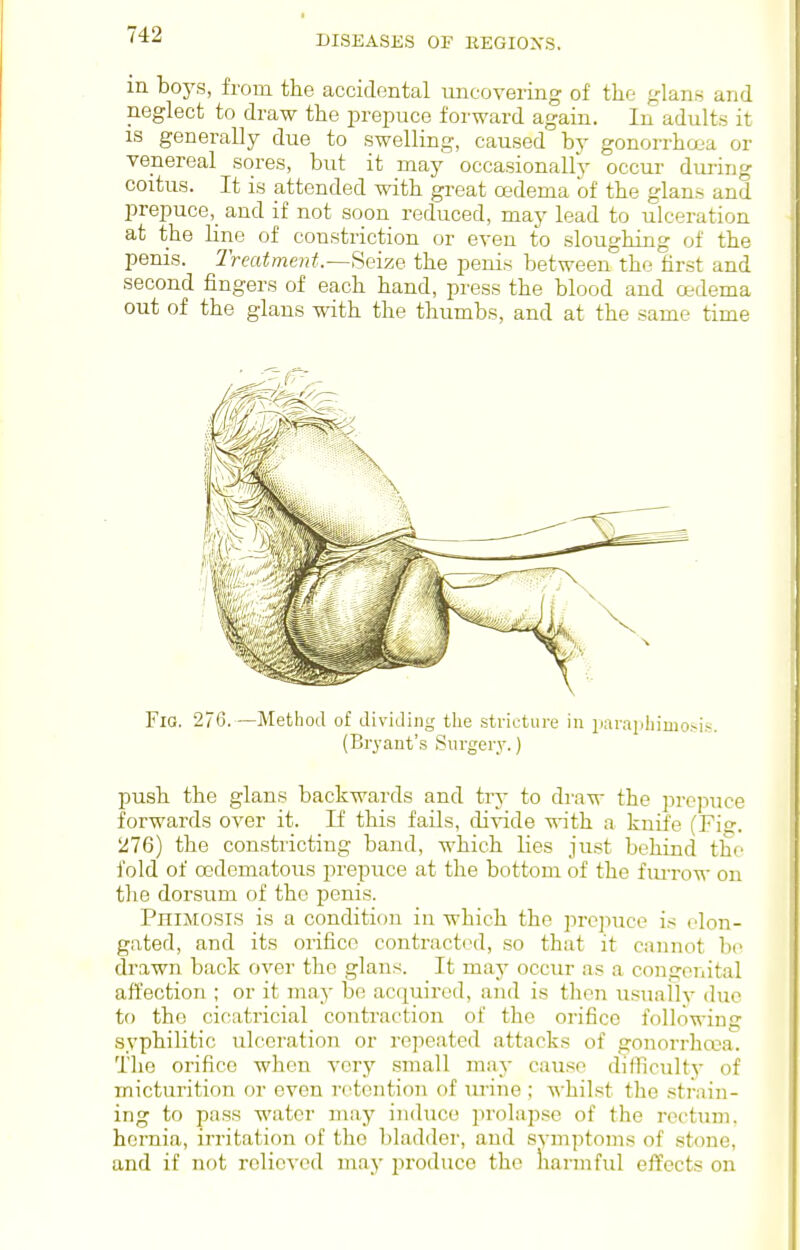 in boys, from the accidental uncovering of tlio glans and neglect to draw the jM-epuco forward again. In adults it IS generally due to swelling, caused by gonorrha'a or venereal sores, but it may occasionally occur duiiiig coitus. It is attended with great oedema of the glans and prepuce,_ and if not soon reduced, may lead to ulceration at the Line of constriction or even to sloughing of the penis. Treatment.—Seize the penis between the hrst and second fingers of each hand, press the blood and oedema out of the glans with the thumbs, and at the same time Fio. 276. —Method of dividing tlie stricture in iiarapliimo.'-is. (Bryant'.s Surgery.) push the glans backwards and trj- to draw the prcpiice forwards over it. If this fails, divide M-ith a knife (Fig. 1^76) the constricting band, which lies just behind the fold of oodomatous prepuce at the bottom of the fiuTow on the dorsum of the penis. Phimosis is a condition in which the pre]nice i.-^: elon- gated, and its orifice contracted, so that it cannot be drawn back over the glans. It may occur as a congenital affection ; or it may be acquired, and is tlien usually due to the cicatricial contraction of the orifice following syphilitic ulceration or repeated attacks of gonorrhcea. The orifice when very small may cause difficulty of micturition or even retention of urine ; whilst the strain- ing to pass water may induce prolapse of the rectum, hernia, irritation of the bladder, and svmjitoms of stone, and if not relieved may produce the liarmful effects on