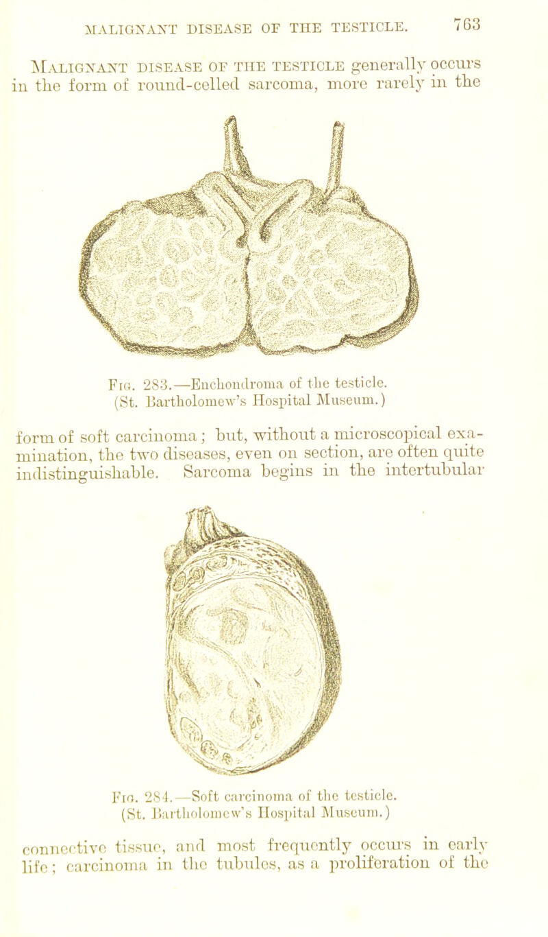 ii.\ligx--\:n't disease of the testicle. Maligx^vnt disease of the testicle generally occurs in the form of rouud-celled sarcoma, more rarely in the FiQ. 283.—EnolioiulroDia of the testicle. (St. Bartliolomew's Hospital Museum.) form of soft carcinoma ; but, without a niicroscopical exa- mination, the two diseases, even on section, are often quite indistinguishable. Sarcoma begins in the intertubular Fro. 284.—Soft carcinouia of tlic testicle. (St. IJartliolomow's Hospital Museum.) connective tissue, and most frequently occurs in early life; carcinoma in the tubules, as a proliferation of the