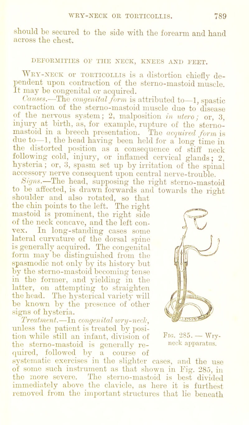 sliould be secured to the side with the forearm and hand across the chest. DEFORMITIES OV THE XECIC, KNEES .-IND EEET. Wry-neck or torticollis is a distortion chiefly de- pendent upon contraction of the steruo-mastoid muscle. It may be congenital or acquired. Causes.—The congenital foi-in is attributed to—1, spastic contraction of the sterno-mastoid muscle duo to disease of _ the nervous system; 2, malposition //; niero; or, 3, injiu-y at bii-th, as, for example, ruptiu'e of the sterno- mastoid in a breech ijresentatiou. The acquired form is due to_—1, the head having been hold for a long time in the distorted position as a consequence of stiff neck following cold, injmy, or inflamed cervical glands; 2, hysteria; or, 3, spasm set up by irritation of the spinal accessory nerve consequent upon central nerve-trouble. tSigns.—The head, supposing the right sterno-mastoid to be affected, is di'awn forwards and towards the right shoulder and also rotated, so that the chin points to the left. The right mastoid is prominent, the right side of the neck concave, and the left con- vex. In long-standing cases some lateral curvatm-e of the doi'sal spine is generally acquired. The congenital form ma}' be distinguished from the spasmodic not only by its history but by the sterno-mastoid becoming tense in the former, and yielding in the latter, on attemjoting to straighten the head. The hysterical variety will be known by the presence of other signs of hysteria. Treatment.—In congeii iial wrij-nccl\ luiless the patient is treated by pcsi- tion while still an infant, division of the sterno-mastoid is generally re- quired, followed by a course of systematic; exercises in the slighter cases, and the use of some such instrument as that shown in I'ig. 285, in the more severe. The sterno-mastoid is best divided immediately above the clavicle, as here it is furthest removed from the important structures that lie beneath Fi(!. 2S5. — Wry- neck apparatus.