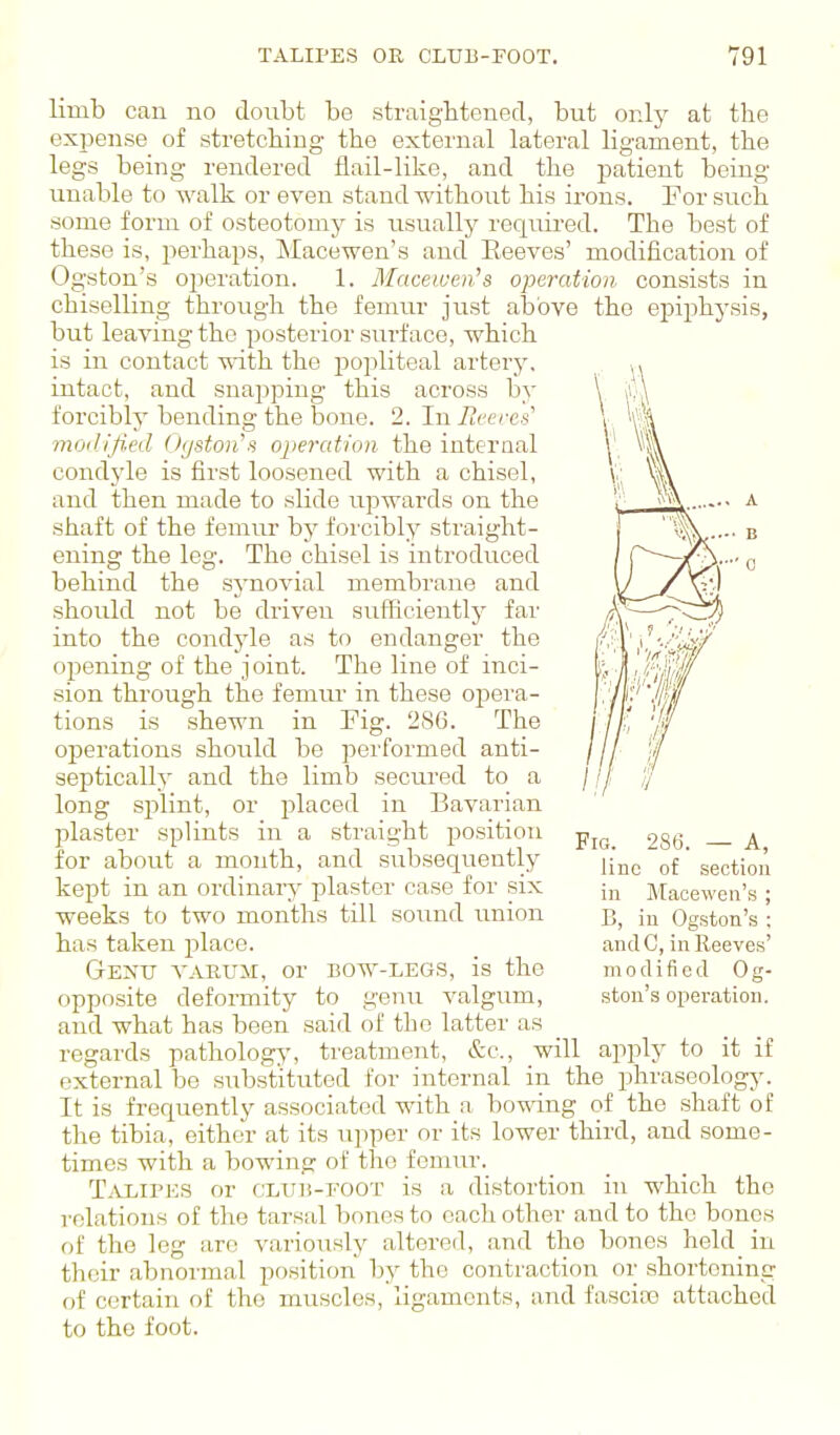 limb can no doubt be straigbtenecT, but only at the expense of stretching the external lateral ligament, the legs being rendered flail-like, and the patient being unable to walk or even stand without his irons. For such some form of osteotomy is tisuall)^ required. The best of these is, perhaps, Macewen's and Beeves' modification of Ogston's operation. 1. Macewen's operation consists in chiselling through the femur just above the epiphysis, but leaving the posterior surface, which is in contact with the popliteal artery, intact, and snapping this across by forcibly bending the bone. 2. In Jlveres'' vtodlfied 0[/ston's opercdion the internal condjde is first loosened with a chisel, and then made to slide upwards on the shaft of the femur by forcibly straight- ening the leg. The chisel is introduced behind the synovial membrane and should not be driven sufficiently far into the condyle as to endanger the opening of the joint. The line of inci- sion through the femur in these oi^era- tions is shewn in Fig. 286. The operations should be performed anti- septically and the limb secured to a long splint, or placed in Bavarian plaster splints in a straight position for about a mouth, and subseqiiently kept in an ordinary plaster case for six weeks to two months till sound union has taken place. Genu taruxt, or bow-legs, is the opposite deformity to genu valgum, and what has been .said of the latter as regards pathology, treatment, &c., will apply to it if external be substituted for internal in the phraseology. It is frequently associated with a bowing of the shaft of the tibia, either at its upper or its lower third, and some- times with a bowing of the femur. Talipes or club-foot is a distortion in which the relations of the tarsal bones to each other and to the bones of the log aro variously altered, and the bones held in their abnormal position by the contraction or shortening of certain of the muscles, ligaments, and fasciro attached to the foot. 1 I' 1 A .... A >/•••• B Fig. 286. — A, line of section in Macewen's ; B, in Ogston's ; andC, inlleeves' modified 0 g- ston's operation.