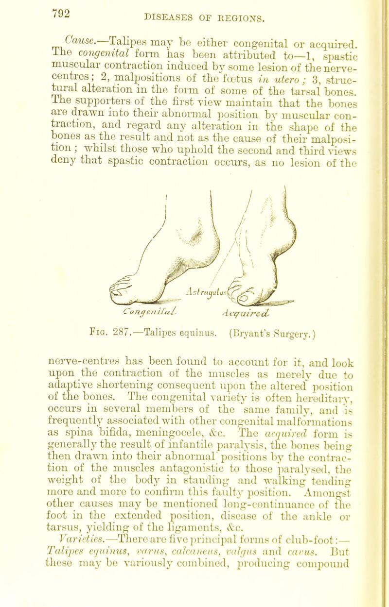 Cause.—Talipes may be either congenital or acquired, ihe congenital form has been attributed to—1, spastic muscular contraction induced by some lesion of the nei-ve- centres; 2, malpositions of the'foetus in utero; 3, struc- tiiral alteration in the form of some of the tarsal bones. The supporters of the first view maintain that the bones are drawn into their abnormal position by muscular con- traction, and regard any alteration in the shape of the bones as the result and not as the cause of their malposi- tion ; whilst those who uphold the second and third A-iews deny that spastic contraction occurs, as no lesion of thr- Cvngen UaL Ace/aircd Fig. 287.—Talijies equiiuis. (Bryant's Surgery.) nerve-centres has been found to account for it, and look upon the contraction of the muscles as merely due to adaptive shortening consequent upon the altered position of the bones. The congenital variety is often hereditary, occurs in several members of the same family, and is frequently associated with other congenital malformations as spina bifida, meningocele, &c. The acquired form is generally the result of infantile paralysis, the bones being then drawn into theu- abnormal' positions by the contrac- tion of the muscles antagonistic to those jiaralysed, tlie weight of the body in standing and M-alking tending more and more to confirm this faulty position. Amongst other causes may be mentioned long-continuance of the foot in the extended position, disease of the ankle or tarsus, yielding of the ligaments, &.c. Varieties.—There are fivo]irincipal forms of club-foot:— Talipes eijuinus, mriis, calaiueus, ralqiis and cams. But these may bo variously combined, ])roducing compound