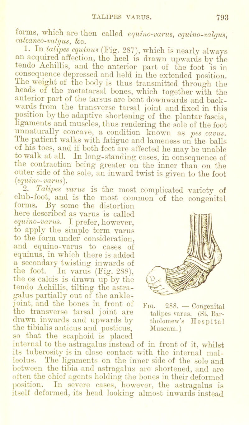 TALIPES VAEUS. V93 forms, vfhich. are then called cqmno-varus, equina-valgus, calcaneo-valgus, &c. 1. Jjo.talipes equinus (Fig. 287), wliicli is nearly always an acquired affection, the heel is drawn upwards by the tendo Achillis, and the anterior part of the foot is in consequence depressed and held in the extended position. The weight of the body is thus transmitted through the heads of the metatarsal bones, which together with the anterior part of the tarsus are bent downwards and back- wards from the transverse tarsal joint and fixed in this IDOsition by the adaptive shortening of the plantar fascia, ligaments and muscles, thus rendering the sole of the foot unnaturally concave, a condition known as pes cavus. The patient walks with fatigue and lameness on the balls of his toes, and if both feet are affected he may be unable to walk at all. In lon.ii-standing cases, in consequence of the contraction beini greater on the inner than on the variety of congenital outer side of the sole, an inward twist is given to the foot (equ'i no-varus). 2. Talipes varus is the most complicated club-foot, and is the most common of the forms. By some the distortion here described as varus is called equino-varus. I prefer, however, to apply the simple term varus to the form under consideration, and equino-varus to cases of eqiunus, in which there is added a secondarj^ twisting inwards of the foot. In varus (Fig. 288), the OS calcis is drawn up by the tendo Achillis, tilting the astra- galus partially out of the ankle- joint, and the bones in front of the transverse tarsal joint are drawn inwards and upwards by the tibialis anticus and posticus, so that the scaphoid is placed internal to the astragalus instead of in front of it, whilst its tuberosity is in ci(5se contact with the internal mal- leolus. The ligaments on the inner side of the sole and Ixitwoen the tibia and astragalus are shortened, and are often the chief agents holding the bones in their deformed position. In severe cases, however, the astragalus is itself deformed, its head looking almost inwards instead Fig. 288. — Congenital talipes varus. (St. Bar- tliolomew's Hospital Museum.)