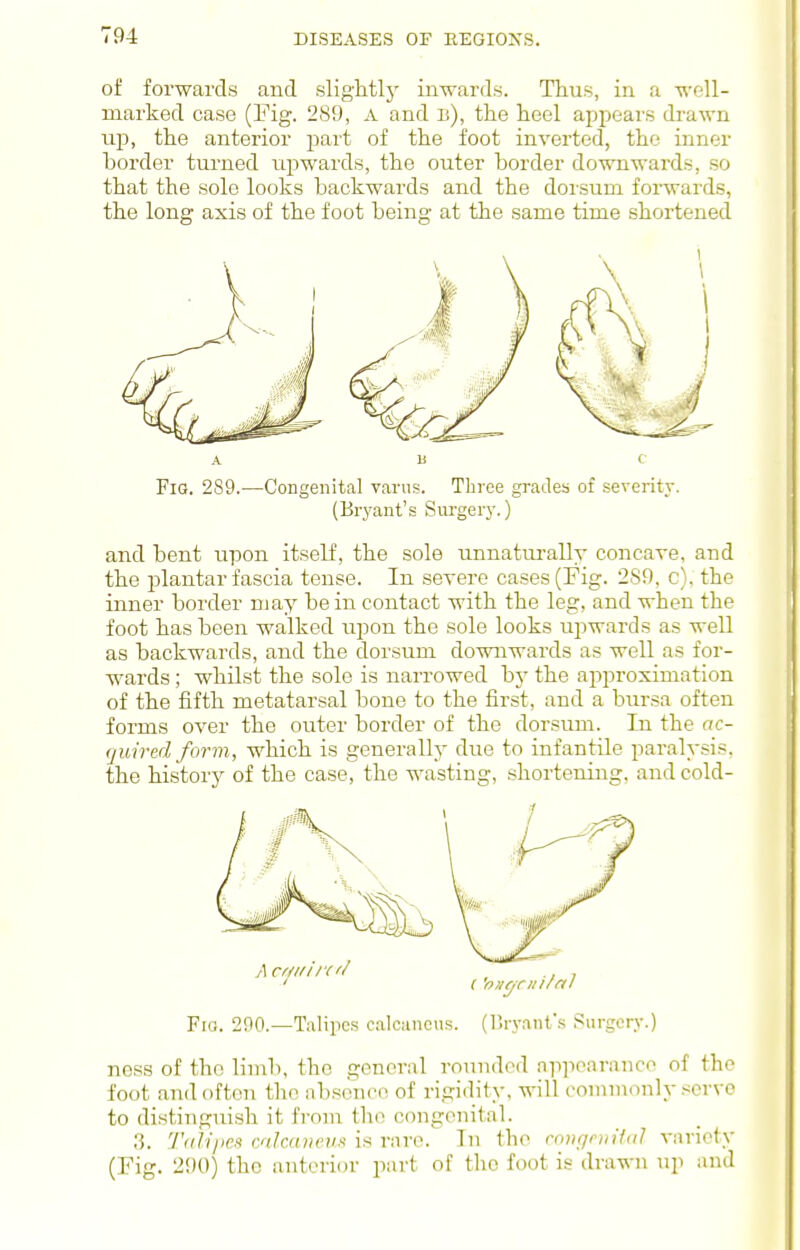 of forwards and slightlj' inwards. Thus, in a wfll- marked case (Fig. 289, A and li), the heel appears drawn up, the anterior part of the foot inverted, the inner border turned upwards, the outer border downwards, so that the sole looks backwards and the doisum forwards, the long axis of the foot being at the same time shortened A li c Fig. 289.—Congenital varus. Three grades of severity. (Bryant's Siu'gery.) and bent upon itself, the sole unnatm-ally concare, and the plantar fascia tense. In severe cases (Fig. 289, c). the inner border njay be in contact with the leg, and when the foot has been walked upon the sole looks upwards as well as backwards, and the dorsum downwards as well as for- wards ; whilst the sole is narrowed bj' the approximation of the fifth metatarsal bone to the first, and a bursa often forms over the outer border of the dorsum. In the oc- quired form, which is generally due to infantile paralysis, the history of the case, the wasting, .shortening, and cold- Fio. 200.—Talipes calcaneus, (liryant's Surgery.) ness of the limb, the general rounded apjiearance of the foot and often the absence of rigidity, will commonly .-^erve to distinguish it from the congenital. .'5. '/'ali/ic-'i mlainerift is rare. In the ro)if/niHiil variety (Fig. 290) the anterior part of the foot is drawn up and