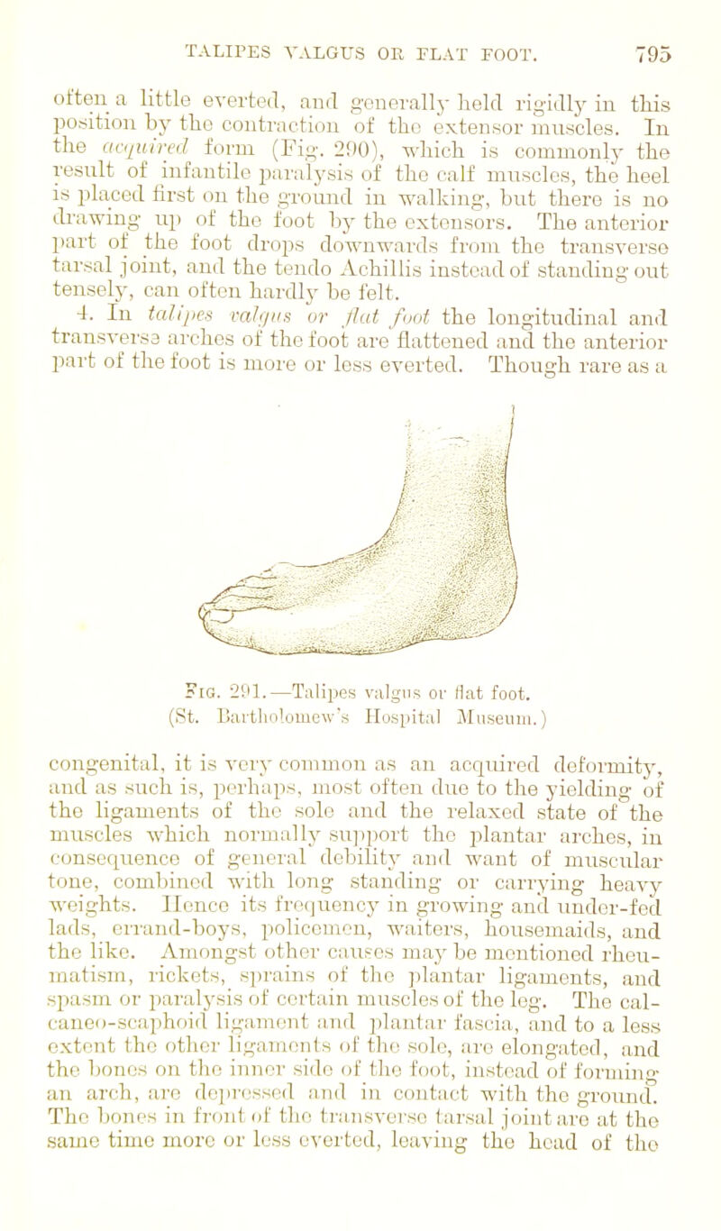 often a little everted, and generally lield rigidly in this position by the contraction of the exten.sor rnnscles. In the acquired form (Fig. 290), which is commonly the resnlt of infantile iiaralysis of the calf mnsclcs, the heel IS placed first on the ground in walking, but there is no drawing up of the foot by the extensors. The anterior part of the foot drops downwards from the transverse tar.sal joint, and the tendo Achillis instead of standing out tensely, can often hardly be felt. 4. In talipes valgus or flat foot the longitudinal and transversa arches of the foot are'flattened and the anterior part of the foot is more or less everted. Though rare as a Fig. 291.—Talipes valgus or Hat foot. (St. ISaitliolomew's Hospital Museum.) congenital, it is very common as an acquired deformity, and as such is, perhaps, most often dne to the yielding of the ligaments of the sole and the I'elaxed state of the mirscles which normallj'- sujiport the plantar arches, in consequence of general debility and want of muscular tone, combined with long standing or carrying heavy weights. Hence its frequency in growing and under-fed lads, errand-boys, policemen, waiters, housemaids, and the like. Amongst other causes maj^ be mentioned rheu- matism, rickets, sprains of the plantar ligaments, and spasm or paralysis of certain muscles of the leg. The cal- canoo-scaphoid Hgamont a,nd iilantar fascia, and to a less extent the other ligaments of the sole, arc elongated, and the bones on the inner side of tlio foot, instead of forming an arch, are do]>rossed a,nd in contact with the ground. The bones in froni of the transverse tarsal joint are at the same time more or loss everted, leaving the head of the