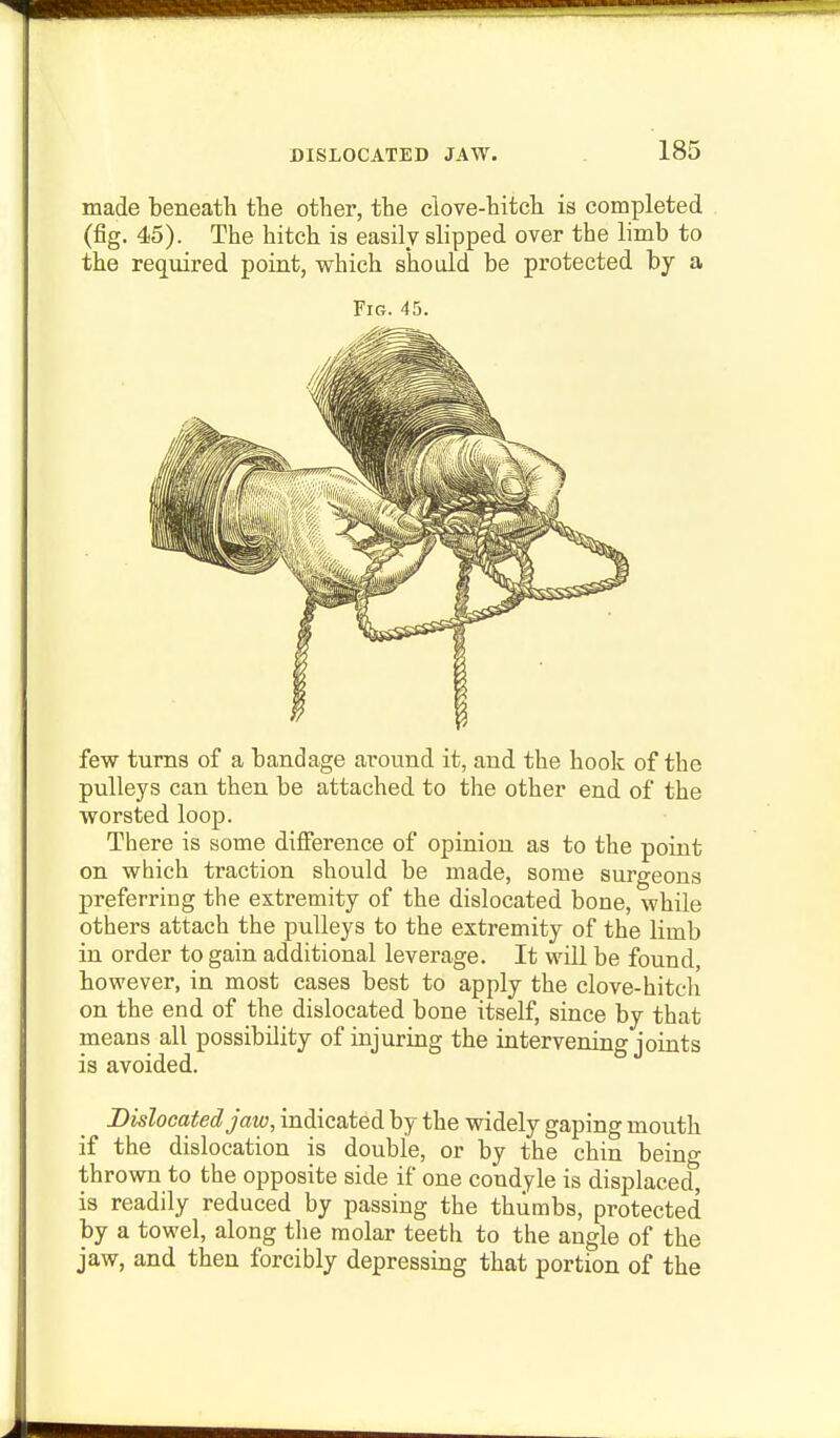 made beneath the other, the clove-hitch is completed (fig. 45). The hitch is easily slipped over the limb to the required point, which should be protected by a Fig. 45. few turns of a bandage around it, and the hook of the pulleys can then be attached to the other end of the worsted loop. There is some difference of opinion as to the point on which traction should be made, some surgeons preferring the extremity of the dislocated bone, while others attach the pulleys to the extremity of the limb in order to gain additional leverage. It will be found however, in most cases best to apply the clove-hitch on the end of the dislocated bone itself, since by that means all possibility of injuring the intervening joints is avoided. Dislocated jaw, indicated by the widely gaping mouth if the dislocation is double, or by the chin being thrown to the opposite side if one condyle is displaced, is readily reduced by passing the thumbs, protected by a towel, along tlie molar teeth to the angle of the jaw, and then forcibly depressing that portion of the