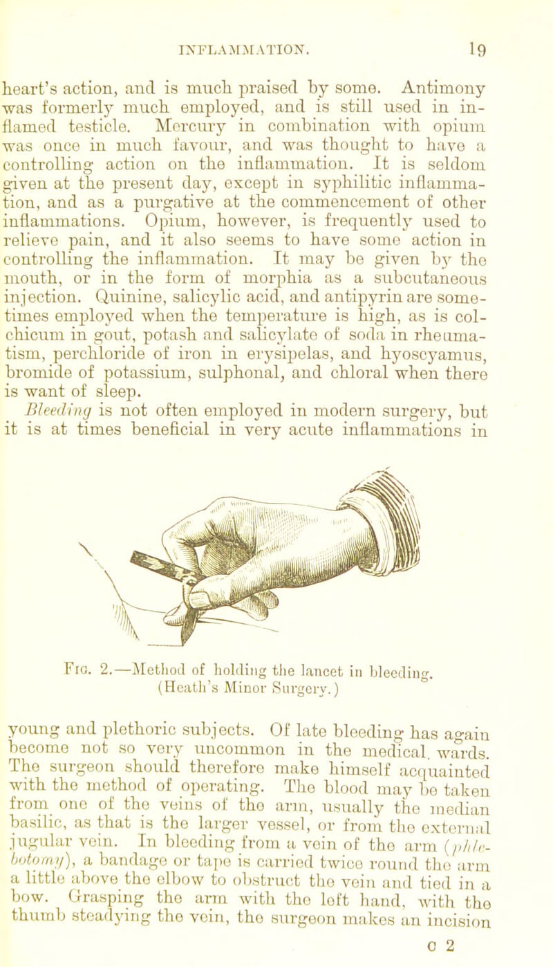 heart's action, and is much praised by some. Antimony was formerly much employed, and is still used in in- flamed testicle. Mercury in combination with opium was once in much favour, and was thought to have a controlling action on the inflammation. It is seldom given at the present day, except in syphilitic inflamma- tion, and as a purgative at the commencement of other inflammations. Opium, however, is frequently used to relieve pain, and it also seems to have some action in controlling the inflammation. It may be given bj^ the mouth, or in the form of morphia as a subcutaneous injection. Quinine, salicylic acid, and antij^yrin are some- times employed when the temperatm-e is high, as is col- chicum in gout, potash and salicylate of soda in rheuma- tism, perchloride of iron in erysipelas, and hyoscyamus, bromide of potassiiun, sulphonal, and chloral when there is want of sleep. Bleed in (J is not often employed in modern surgery, but it is at times beneficial in very acute inflammations in Fro. 2.—Method of holding the lancet in bleeding. (Heatli's Minor Surgery.) young and plethoric subjects. Of late bleeding has again become not so very uncommon in the medical, wards. The surgeon should therefore make himself acquainted with the method of operating. The blood may be taken from one of the veins of the arm, usually the median basilic, as that is the larger vessel, or from the external jugular vein. In bleeding from a vein of the arm (/;///r- botomy), a bandage or tajie is carried twice round tho arm a little above the elbow to obstruct tho vein and tied in a bow. Grasping tho arm with tho loft hand, with the thumb steadying tho vein, tho surgeon makes an incision 0 2