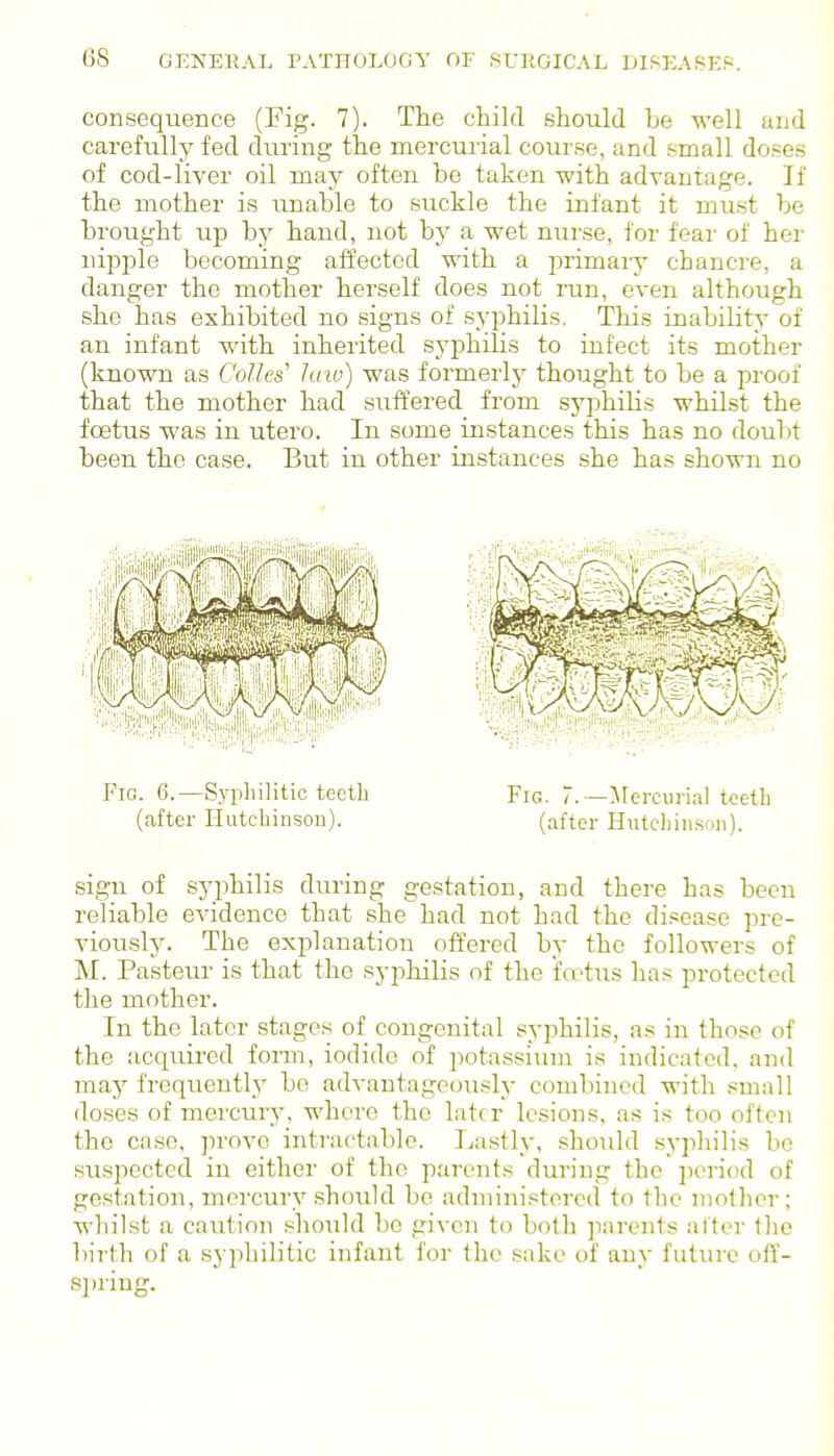 consequence (Fig. 7). The child should be well and carefully fed during the mercurial course, and small doses of cod-liver oil may often be taken with advantage. If the mother is unable to suckle the infant it must be brought up by hand, not bj' a wet nurse, for fear of her nipi^le becoming affected with a primary chanci-e, a danger the mother herself does not run, even although she has exhibited no signs of syphilis. This inability of an infant with inherited syjjhilis to infect its mother (known as Colics' hvw) was formerlj' thought to be a proof that the mother had suffered from syphilis whilst the foetus was in utero. In some instances this has no doubt been the case. But in other instances she has shown no sign of syphilis during gestation, and there has been reliable evidence that she had not had the disease pre- viously. The explanation offered by the followers of M. Pasteur is that the syphilis of the foetus lias protected the mother. In the later stages of congenital syphilis, as in those of the acquired form, iodide of potassium is indicated, and may frequently be adA-antageously combined with small doses of mercury, where the later lesions, as is too often the case, prove intractable. Lastly, should syphilis be suspected in either of the parents during the ])eriod of gestation, mercury should be administered to the mother; whilst a caution should be given to both ]iarents alter tlie birth of a syphilitic infant for the sake of any future off- spring.