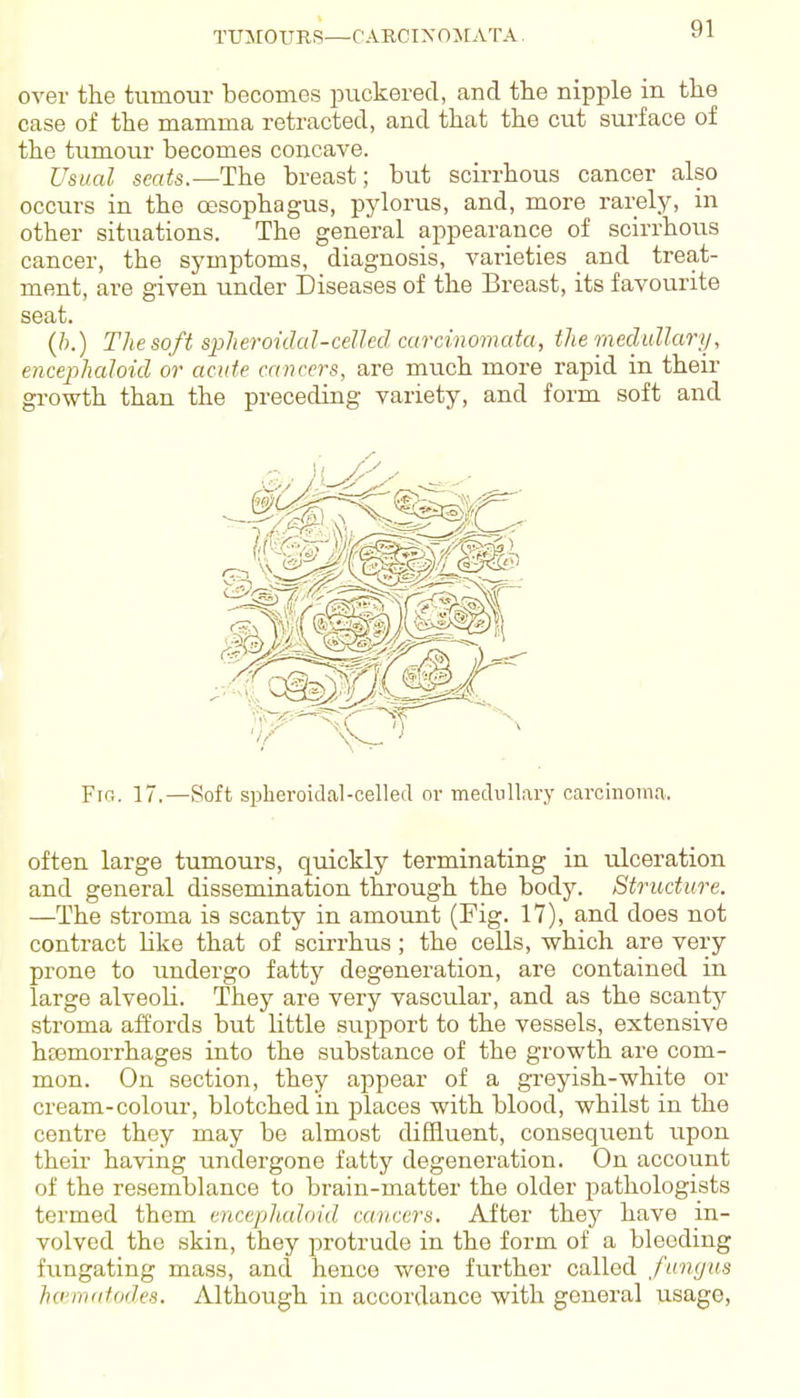 TUMOTJRS—I CARCTXOjrATA over the tumour becomes puckered, and the nipple in the case of the mamma retracted, and that the cut surface of the tumour becomes concave. Usual seats—ThQ breast; but scirrhous cancer also occurs in the oesophagus, pylorus, and, more rarely, in other situations. The general appearance of scirrhous cancer, the symptoms, diagnosis, varieties and treat- ment, are given under Diseases of the Breast, its favourite seat. (ft.) Thesoft spheroidal-celled carcinomata, the medullary, encephaloid or acute cancers, are much more rapid in theii- gi-owth than the preceding variety, and form soft and often large tumours, quickly terminating in ulceration and general dissemination through the body. Structure. —The stroma is scanty in amount (Fig. 17), and does not contract Hke that of scirrhus; the cells, which are very prone to undergo fatty degeneration, are contained in large alveoli. They are very vascular, and as the scanty stroma affords but little support to the vessels, extensive hfemorrhages into the substance of the growth are com- mon. On section, they appear of a greyish-white or cream-colour, blotched in places with blood, whilst in the centre they may be almost diffluent, consequent upon their having undergone fatty degeneration. On account of the resemblance to brain-matter the older pathologists termed them encepJi.aloid cancers. After they have in- volved the skin, they protrude in the form of a bleeding fungating mass, and hence were further called fungus ho'iivitodes. Although in accordance with general usage.