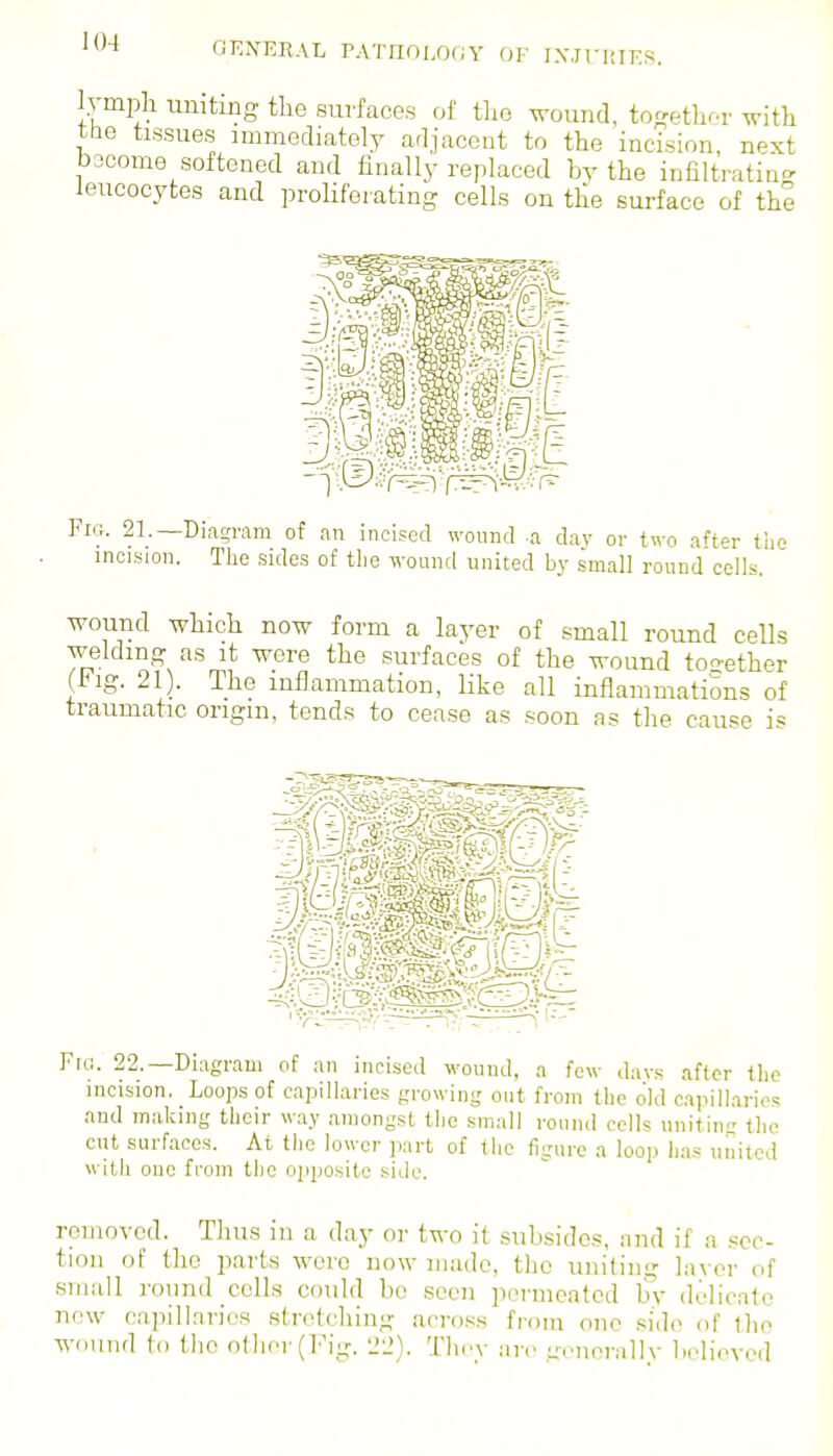 KM GENERAL rATnOLOOY f)F IXJTI!IER. l.vmph uniting the sui-faces of tlio wound, togethor with the tissues immediately adjacent to the incision, next b3come softened and finally replaced by the infiltratia- leucocytes and proliferating cells on the surface of the Fig. 21.—Diagram of an incised wound .a day or two after the incision. Tlie sides of tlie wound united by small round colls. wound which now form a layer of small round cells welding as it were the surfaces of the wound tooether (Fig. 21). The inflammation, like all inflammations of traumatic origin, tends to cease as soon as the cause is Fici. 22.—Diagram of an incised wound, a few days after the incision. Loops of capillaries growing out from the old c.ipillarios and making their way .amongst the small round cells unitim: the cut surfaces. At the lower part of the figure a loop has united with one from the oiiposite side. removed. Thus in a day or two it subsides, and if a sec- tion of the parts were now made, the uniting layer of small round cells could bo seen permeated b\- delicate now capillaries stretching across from one side of the wound to tlie otlioi'(rig. '22). Thev an- -oncrallv b(>Hoved