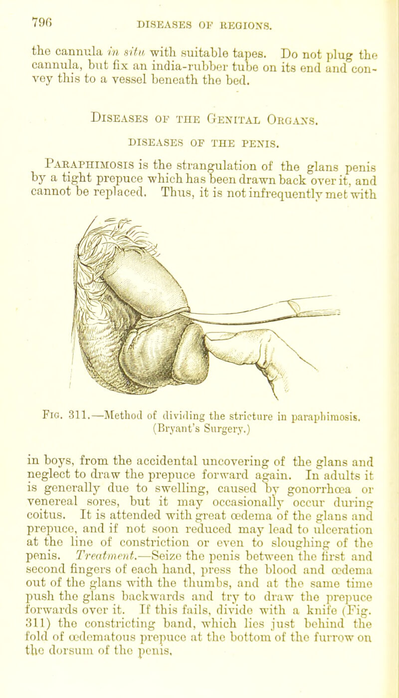 790 the cannula in situ with suitable tapes. Do not plug tho cannula, but fix an india-rubber tube on its end and con- vey this to a vessel beneath the bed. . . Diseases of the Gexital Orga>-s. diseases of the penis. Pahaphimosis is the strangulation of the glans penis by a tight prepuce which has been drawn back over it, and cannot be rejDlaced. Thus, it is not infi-equently met with Fig. 311.—Method of diviiling the stricture in paraphimosis. (Bryant's Surgery.) in boys, from the accidental uncovering of the glans and neglect to di'aw the ju-epuce forward again. In adults it is generally due to swelling, caused by gonorrho'a or venereal sores, but it may occasionally occur dm-ing coitus. It is attended with great cedema of the glans and prepuce, and if not soon reduced may lead to ulceration at the line of constriction or even to sloughing of the penis. Treatmrrd.—Seize the penis between the first and second fingers of each hand, press the blood and oodema out of the glans with the thumbs, and at the same time push the glans backwards and try to draw the prepuce forwards over it. If this fails, divide with a knife (Fig. 311) the constricting band, which lies just behind the fold of oedematous prepuce at the bottom of the furrow on the dorsum of the penis.