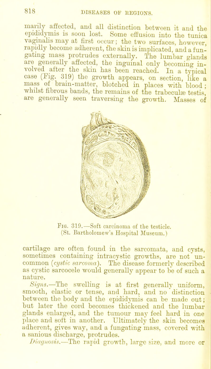 manly affected, and all distinction between it and the epididymis is soon lost. Some effusion into the tunica vaginalis may at first occur; the two surfaces, however, rapidly become adherent, the skin is implicated, and a fun- gating mass protrudes externally. The lumbar glands are generally affected, the inguinal only becoming in- volved after the skin has been reached. In a typical case (Fig. 319) the growth appears, on section, like a mass of brain-matter, blotched in places with blood ; ■whilst fibrous bands, the remains of the trabeculse testis^ are generally seen traversing the growth. Masses of Fig. 319.—Soft carcinoma of the testicle. (St. Bartholomew's Hospital Jluseum.) cartilage are often found in the sarcomata, and cysts, sometimes containing intracystic growths, are not un- common {cystic sarcoma). The disease formerly described as cystic sarcocele would generallj' appear to be of such a nature. Sifjns.—The swelling is at first generally uniform, smooth, elastic or tense, and hard, and no distinction between the bodj^ and the epididj-mis can be made out ; but later the cord becomes thickened and the lumbar glands enlarged, and the tumour may feci hard in one place and soft in another. Ultimntcly the skin becomes adherent, gives way, and a fungating mass, covered with a sanioiis discharge, protrudes. J)i(i<luosis.—The Y\\\m\ growth, large size, and more or