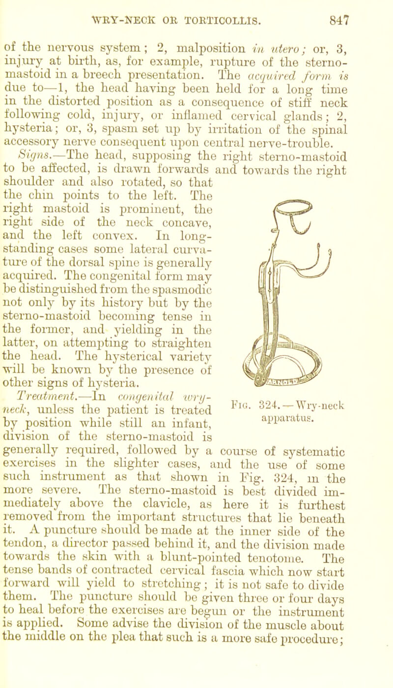 of the nervous system; 2, malposition in utero; or, 3, injiuy at birth, as, for example, rupture of the steruo- mastoid in a breech presentation. The acquired form is due to—1, the head having been held for a long time in the distorted position as a consequence of stiff neck following cold, injury, or inflamed cervical glands; 2, hysteria; or, 3, spasm set up by irritation of the spinal accessory nerve consequent upon central nerve-trouble. Signs.—The head, supposing the right sterno-mastoid to be affected, is drawn forwards and towards the right shoulder and also rotated, so that the chin points to the left. The right mastoid is prominent, the right side of the neck concave, and the left convex. In long- standing cases some lateral curva- tui'e of the dorsal spine is generally acquired. The congenital form may be distinguished from the spasmodic not only by its history but by the sterno-mastoid becoming tense in the foi-mer, and yielding in the latter, on attempting to straighten the head. The hysterical variety will be known by the presence of other signs of hysteria. Treatment.—In cungenital ■wrg- ^_ neck, unless the patient is treated '• 324. —Wry-neck by position while still an infant, apparatus, division of the sterno-mastoid is generally required, followed by a course of systematic exercises in the slighter cases, and the use of some such instrument as that shown in Fig. 324, m the more severe. The sterno-mastoid is best divided im- mediately above the clavicle, as here it is furthest removed from the important structures that lie beneath it. A punctui-e should be made at the inner side of the tendon, a director passed behind it, and the division made towards the skin with a blunt-pointed tenotome. The tense bands of contracted cervical fascia which now start foi-ward will yield to stretching; it is not safe to divide them. The puncture should be given three or fom- days to heal before the exercises are begmi or the instrument is applied. Some advise the division of the muscle about the middle on the plea that such is a more safe procedure;