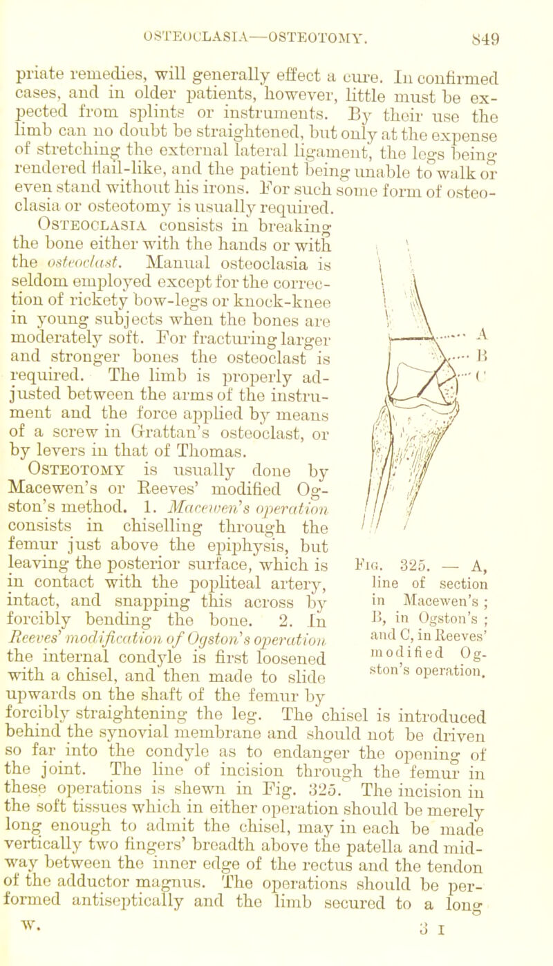 A B priate remedies, will generally effect a ciu-e. In confirmed cases, and in older patients, however, little must be ex- pected from splints or instruments. By their use the limb can no doubt be straightened, but only at the expense of stretching the external lateral ligament, the legs beino- rendered tiail-like, aud the patient being unable to walk or even stand without his irons. Por such souie form of osteo- clasia or osteotomy is usually required. Osteoclasia consists in breaking the bone either with the hands or with \ \ the vsfc(ic/a.^f. Manual osteoclasia is seldom employed except for the correc- tion of rickety bow-legs or knock-knee in young subjects when the bones are moderately soft. For fractiu-ing larger and stronger bones the osteoclast is requii-ed. The limb is properly ad- justed between the arms of the instru- ment aud the force appHed by means of a screw in Grrattan's osteoclast, or by levers in that of Thomas. Osteotomy is usually done by Mace wen's or Eeeves' modified Og- ston's method. 1. Maceiven's operation consists in chiselling through the femur just above the epiphysis, but leaving the po.sterior surface, which is in contact with the popliteal artery, intact, and snapping this across by forcibly bending the bone. 2. lii Beeves' modification of Ogston's operation. the internal condjde is first loosened with a chisel, and then made to slide upwards on the shaft of the femur by forcibly straightening the leg. The chisel is introduced behind the synovial membrane and should not be driven so far into the condyle as to endanger the opening of the joint. The Kne of incision through the femur in these operations is shewn in Fig. 325. The incision in the soft tissues which in either operation should be merely long enough to admit the chisel, may in each be made vertically two fingers' breadth above the patella and mid- way between the inner edge of the rectus and the tendon of the adductor magnus. The operations should be per- formed antisoptically and the limb secured to a long 325. — A, line of section in Macewen's ; ]!, in Ogston's ; and C, inReeve.s' modifiecl Og- .ston's operation. W. 6 I