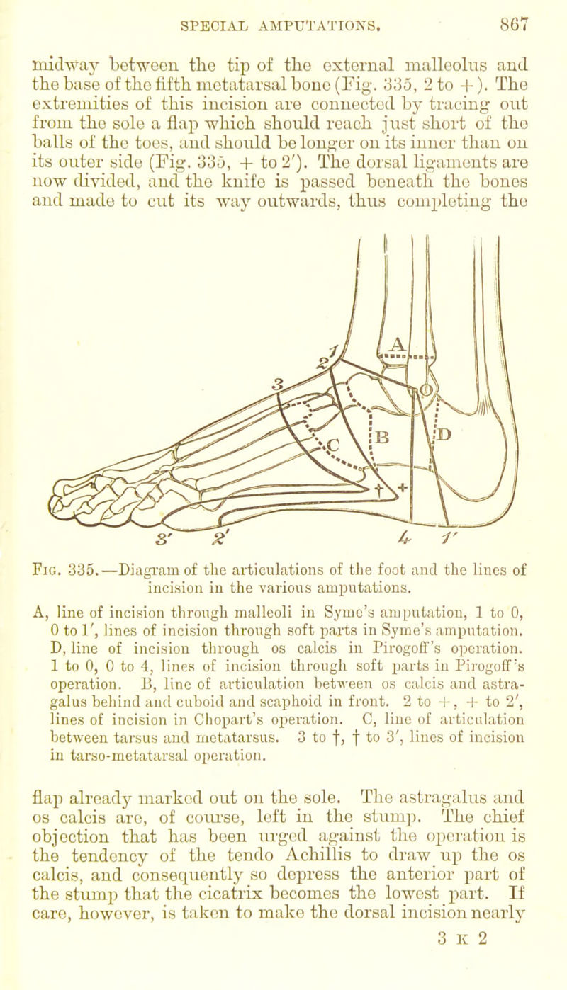 niichvay between the tip of the external malleolus and the base of the fifth metatarsal bone (Fig. olio, 2 to +). The extremities of this incision are connected by tmcing out from the sole a flap which should I'each just short of the balls of the toes, and should be longer on its inner than on its outer side (Fig. 33u, + to 2'). The dorsal ligaments are now divided, and the knife is passed beneath the bones and made to cut its way outwards, thus completing the Fig. 335.—Diagi'am of tlie articulations of tlie foot and the lines of incision in the various amijutations. A, line of incision through malleoli in Syme's amputation, 1 to 0, 0 to 1', lines of incision through soft parts in Syme's amputation. D, line of incision through os calcis in Pirogofls operation. 1 to 0, 0 to 4, lines of incision through soft parts in Pirogoff s operation. B, line of articulation between os calcis and astra- galus behind and cuboid and scaphoid in front. 2 to +, + to 2', lines of incision in Chopart's oijeration. C, line of articulation between tarsus and metatarsus. 3 to f, f to 3', lines of incision in tarso-metatarsal operation. flap already marked out on the sole. The astragalus and OS calcis arc, of coiu'se, left in the stump. The chief objection that has been lu-ged against the operation is the tendency of the tendo Achillis to draw up the os calcis, and consequently so depress the anterior part of the stump that the cicatrix becomes the lowest part. If care, however, is taken to make the dorsal incision nearly 3 K 2