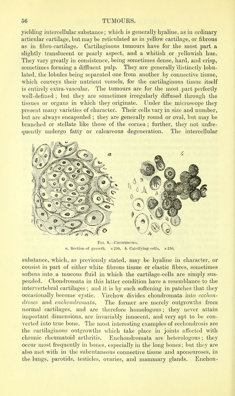 yielding intercellular substance; wliich is generally hyaline, as in ordinary articular cartilage, but may be reticulated as in yellow cartilage, or fibrous as in fibro-cartilage. Cartilaginous tumours have for the most part a slightly translucent or pearly aspect, and a whitish or yellowish hue. They vary greatly in consistence, being sometimes dense, hard, and crisp, sometimes forming a diffluent pulp. They are generally 'distinctly lobu- lated, the lobules being separated one from another by connective tissue, which conveys their nutrient vessels, for the cartilaginous tissue itself is entirely extra-vascular. The tumours are for the most part perfectly well-defined ; but they are sometimes irregularly dift'used through the tissues or organs in which they originate. Under the microscope they present many varieties of character. Their cells vary in size and number, but are always encapsuled ; they are generally round or oval, but may be branched or stellate like those of the cornea ; further, they not unfr-e- quently undergo fatty or calcareous degeneration. The intercellular Fig. 8.—Chondroma. a. Section of growth. x250. 6. Calcifyiug cells. x250. substance, which, as previously stated, may be hyaline in character, or consist in part of either white fibrous tissue or elastic fibres, sometimes softens into a mucous fluid in which the cartilage-cells are simply sus- pended. Chondromata in this latter condition have a resemblance to the intervertebral cartilages ; and it is by such softening in patches that they occasionally become cystic. Virchow divides chondromata into ccchon- clroses and enchondromata. The former are merely outgrowths from normal cartilages, and are therefore homologous; they never attain important dimensions, are invariably innocent, and very apt to be con- verted into true bone. The most interesting examples of ecchondrosis are the cartilaginous outgrowths which take place in joints affected with chronic rheumatoid arthritis. Enchondromata are heterologous ; they occur most frequently in bones, especially in the long bones; but they are also met with in the subcutaneous connective tissue and aponeuroses, in the lungs, parotids, testicles, ovaries, and mammary glands. Enchon-