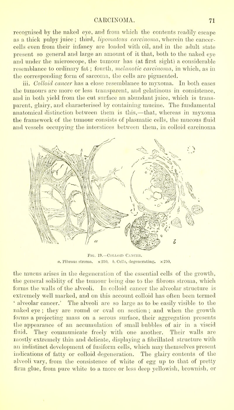 recognised by the naked eye, and from which the contents readily escape as a thick pnlpy juice; third, liijomatous corcMzoj^ift, wherein the cancer- cells even from their infancy are loaded with oil, and in the adult state present so general and large ari amount of it that, both to the naked eye and under the microscope, the tumour has (at first sight) a considerable resemblance to ordinary fat; fourth, melanotic carcinoma, in which, as in the corresponding form of sarcoma, the cells are pigmented. iii. Colloid cancer has a close resemblance to myxoma. In both cases the tumours are more or less transparent, and gelatinous in consistence, and in both yield from the cut surface an abundant juice, which is trans- parent, glairy, and characterised by containing mucine. The fundamental anatomical distinction between them is this,—that, whereas in myxoma the fi-amework of the tumour consists of plasmatic cells, the mucous fluid and vessels occupying the interstices between them, in colloid carcinoma Fig. 19.—Coi.miid CAXcun. n. Fibrous stroniii. x250. 6. Cells, degenerating. x250. the mucus arises in the degeneration of the essential cells of the growth, the general solidity of the tumour being due to the fibrous stroma, which forms the walls of the alveoli. In colloid cancer the alveolar structure is extremely well marked, and on this account colloid has often been termed ' alveolar cancer.' The alveoli are so large as to be easily visible to the naked eye ; they are round or oval on section ; and when the growth forms a projecting mass on a serous surface, their aggregation presents the appearance of an accumulation of small bubbles of air in a viscid fluid. They communicate freely with one another. Their walls are mostly extremely thin and delicate, displaying a fibrillated structure with an indistinct development of fusiform cells, which may themselves present indications of fatty or colloid degeneration. The glairy contents of the alveoli vary, from the consistence of white of egg up to that of pretty firm glue, from pure white to a more or less deep yellowish, brownish, or