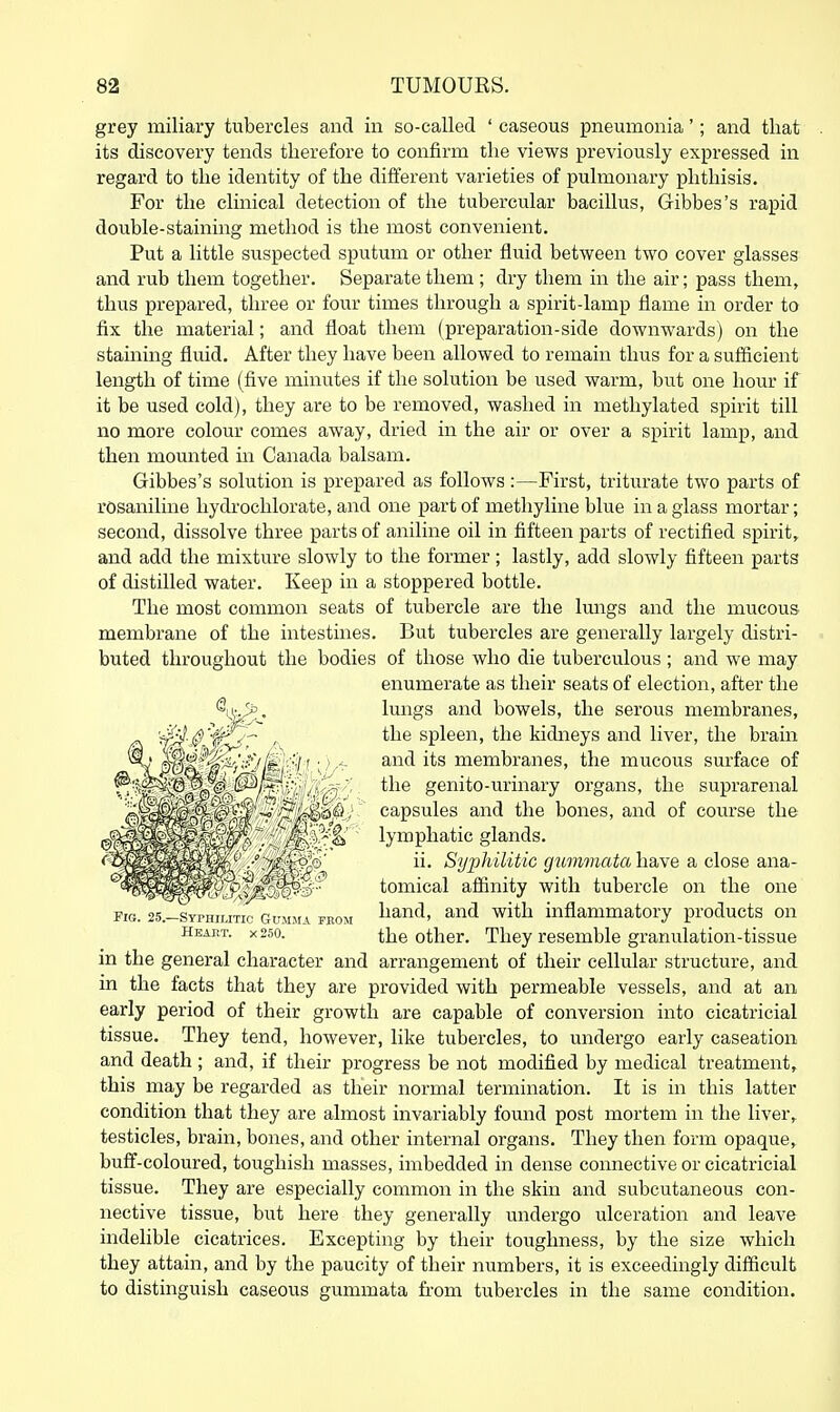 grey miliary tubercles and in so-called ' caseous pneumonia'; and that its discovery tends therefore to confirm the views previously expressed in regard to the identity of the different varieties of pulmonary phthisis. For the clinical detection of the tubercular bacillus, Gibbes's rapid double-staining method is the most convenient. Put a little suspected sputum or other fluid between two cover glasses and rub them together. Separate them ; dry them in the air; pass them, thus prepared, three or four times through a spirit-lamp flame in order to fix the material; and float them (preparation-side downwards) on the staining fluid. After they have been allowed to remain thus for a sufficient length of time (five minutes if the solution be used warm, but one hour if it be used cold), they are to be removed, washed in methylated spirit till no more colour comes away, dried in the air or over a spirit lamp, and then mounted in Canada balsam. Gibbes's solution is prepared as follows:—First, triturate two parts of rosanilme hydrochlorate, and one part of methyline blue in a glass mortar; second, dissolve three parts of aniline oil in fifteen parts of rectified spirit,, and add the mixture slowly to the former; lastly, add slowly fifteen parts of distilled water. Keep in a stoppered bottle. The most common seats of tubercle are the lungs and the mucous membrane of the intestines. But tubercles are generally largely distri- buted throughout the bodies of those who die tuberculous ; and we may enumerate as their seats of election, after the •^ii^^. lungs and bowels, the serous membi'anes, '^.^1^- the spleen, the kidneys and liver, the brain (j-^fj\l 1^0. l< ' and its membranes, the mucous surface of ^e'M? P/--' the genito -urinary organs, the suprarenal r'f^^P-' capsules and the bones, and of course the lymphatic glands. ii. Sy^Mlitic gummata have a close ana- tomical affinity with tubercle on the one Fig 25-SYriuriTi-GuMM- fkom liand, and with inflammatory products on Hi,Ai,,T. x25o. the other. They resemble granulation-tissue in the general character and arrangement of their cellular structure, and in the facts that they are provided with permeable vessels, and at an early period of their growth are capable of conversion into cicatricial tissue. They tend, however, like tubercles, to undergo early caseation and death ; and, if their progress be not modified by medical treatment, this may be regarded as their normal termination. It is in this latter condition that they are almost invariably found post mortem in the liver, testicles, brain, bones, and other internal organs. They then form opaque, buff-coloured, toughisli masses, imbedded in dense connective or cicatricial tissue. They are especially common in the skin and subcutaneous con- nective tissue, but here they generally undergo ulceration and leave indelible cicatrices. Excepting by their toughness, by the size which they attain, and by the paucity of their numbers, it is exceedingly difficult to distinguish caseous gummata from tubercles in the same condition.