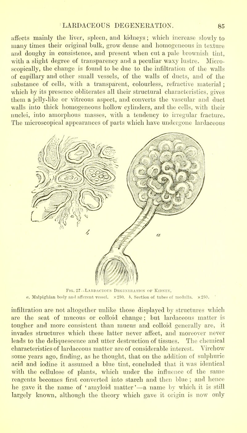 affects mainly the liver, spleen, and kidneys ; wliich increase slowly to many times their original bulk, grow dense and homogeneous in texture and doughy in consistence, and present when cut a pale brownish tint, with a slight degree of transparency and a peculiar waxy lustre. Micro- scopically, the change is found to be due to the infiltration of the walls of capillary and other small vessels, of the walls of ducts, and of the substance of cells, with a transparent, colourless, refractive material; which by its presence obliterates all their structural characteristics, gives them a jelly-like or vitreous aspect, and converts the vascular and duct walls into thick homogeneous hollow cylinders, and the cells, with their nuclei, into amorphous masses, with a tendency to irregular fracture. The microscopical appearances of parts which have undergone lardaceous Fig. 27--LAI1DACEOUS Degexeration of Kidney. a. Malpighian body ami afferent vessel. x250. Ii. Section of tubes of mednlla, x250. infiltration are not altogether unlike those displayed by structures which are the seat of mucous or colloid change; but lardaceous matter is tougher and more consistent than mucus and colloid generally are, it invades structures which these latter never affect, and moreover never leads to the deliquescence and utter destruction of tissues. The chemical characteristics of lardaceous matter are of considerable interest. Virchow some years ago, finding, as he thought, that on the addition of sulphuric acid and iodine it assumed a blue tint, concluded that it was identical with the cellulose of plants, which under the influence of the same reagents becomes first converted into starch and then blue ; and hence he gave it the name of 'amyloid matter'—a name by which it is still largely known, although the theory wliich gave it origin is now only