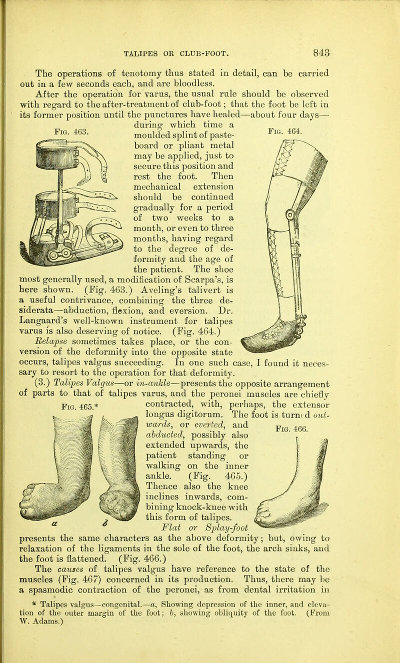 Pig. 463. Fig. 464. The operations of tenotomy thus stated in detail, can be carried out in a few seconds each, and are bloodless. After the operation for varus, the usual rule should be observed with regard to the after-treatment of club-foot; that the foot be left in its former position until the punctures have healed—about four days— during which time a moulded splint of paste- board or pliant metal may be applied, just to secure this position and rest the foot. Then mechanical extension should be continued gradually for a period of two weeks to a month, or even to three months, having regard to the degree of de- formity and the age of the patient. The shoe most generally used, a modification of Scarpa's, is here shown. (Fig. 463.) Aveling's talivert is a useful contrivance, combining the three de- siderata—abduction, flexion, and eversion. Dr. Langaard's well-known instrument for talipes varus is also deserving of notice. (Fig. 464.) Relapse sometimes takes place, or the con- version of the deformity into the opposite state occurs, talipes valgus succeeding. In one such case, I found it neces- sary to resort to the operation for that deformity. (3.) Talipes Valgus—or in-ankle—presents the opposite arrangement of parts to that of talipes varus, and the peronei muscles are chiefly Fig. 465.* contracted, with, perhaps, the extensor longus digitorum. The foot is turni d out- wards, or everted, and abducted, possibly also extended upwards, the patient standing or walking on the inner ankle. (Fig. 465.) Thence also the knee inclines inwards, com- bining knock-knee with this form of talipes. Flat or Splay-foot presents the same characters as the above deformity; but, owing to relaxation of the ligaments in the sole of the foot, the arch sinks, and the foot is flattened. (Fig. 466.) The causes of talipes valgus have reference to the state of the muscles (Fig. 467) concerned in its production. Thus, there may be a spasmodic contraction of the peronei, as from dental irritation in * Talipes valgus—congenital.—a, Showing depression of the inner, and eleva- tion of the outer margin of the foot; 6, showing obliquity of the foot. (From W. Adams.) Fig. 466. 3