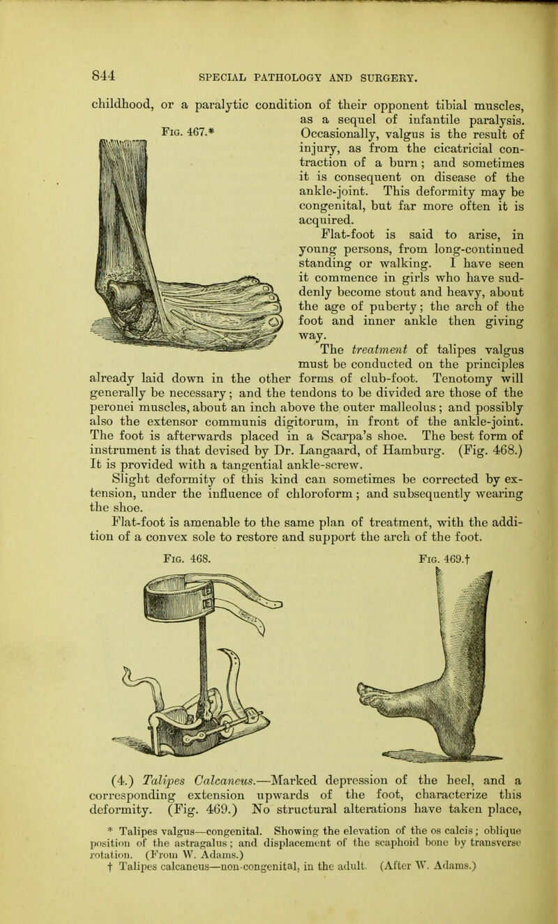 Fig. 467.* childhood, or a paralytic condition of their opponent tibial muscles, as a sequel of infantile paralysis. Occasionally, valgus is the result of injury, as from the cicatricial con- traction of a burn ; and sometimes it is consequent on disease of the ankle-joint. This deformity may be congenital, but far more often it is acquired. Flat-foot is said to arise, in young persons, from long-continued standing or walking. I have seen it commence in girls who have sud- denly become stout and heavy, about the age of puberty; the arch of the foot and inner ankle then giving way. The treatment of talipes valgus must be conducted on the principles already laid down in the other forms of club-foot. Tenotomy will generally be necessary; and the tendons to be divided are those of the peronei muscles, about an inch above the outer malleolus ; and possibly also the extensor communis digitorum, in front of the ankle-joint. The foot is afterwards placed in a Scarpa's shoe. The best form of instrument is that devised by Dr. Langaard, of Hamburg. (Fig. 468.) It is provided with a tangential ankle-screw. Slight deformity of this kind can sometimes be corrected by ex- tension, under the influence of chloroform; and subsequently wearing the shoe. Flat-foot is amenable to the same plan of treatment, with the addi- tion of a convex sole to restore and support the arch of the foot. Fig. 468. Fig. 469.f (4.) Talipes Calcaneus.—Marked depression of the heel, and a corresponding extension upwards of the foot, characterize this deformity. (Fig. 469.) No structural alterations have taken place, * Talipes valgus—congenital. Showing the elevation of the os calcis ; oblique position of the astragalus ; and displacement of the scaphoid bone by transverse rotation. (From W. Adams.) t Talipes calcaneus—non-congenital, in the adult. (After W. Adams.)
