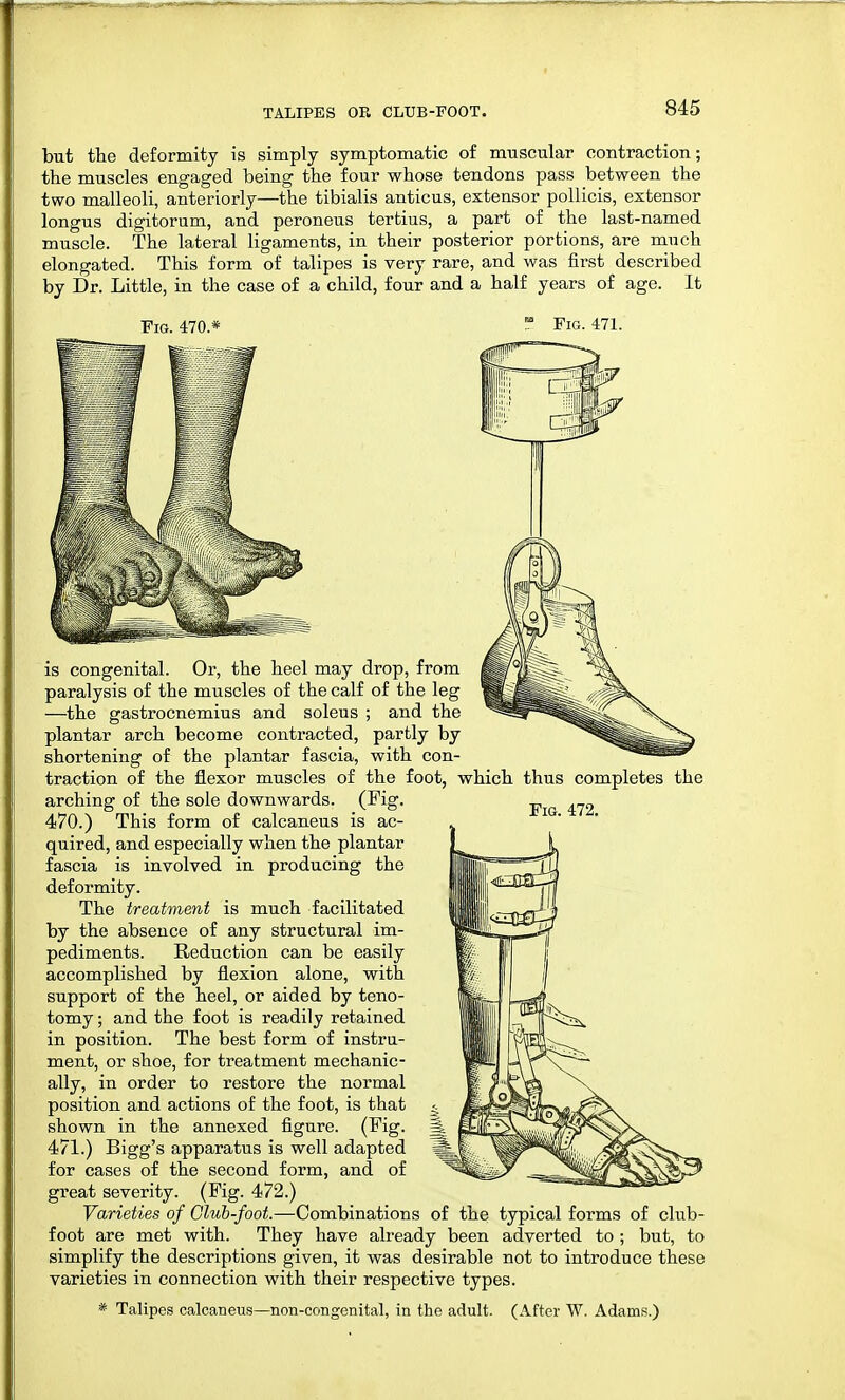 but the deformity is simply symptomatic of muscular contraction; the muscles engaged being the four whose tendons pass between the two malleoli, anteriorly—the tibialis anticus, extensor pollicis, extensor longus digitorum, and peroneus tertius, a part of the last-named muscle. The lateral ligaments, in their posterior portions, are much elongated. This form of talipes is very rare, and was first described by Dr. Little, in the case of a child, four and a half years of age. It Fig. 470.* Fig. 471. Fig. 472. is congenital. Or, the heel may drop, from paralysis of the muscles of the calf of the leg —the gastrocnemius and soleus ; and the plantar arch become contracted, partly by shortening of the plantar fascia, with con- traction of the flexor muscles of the foot, which thus completes the arching of the sole downwards. (Fig. 470. ) This form of calcaneus is ac- quired, and especially when the plantar fascia is involved in producing the deformity. The treatment is much facilitated by the absence of any structural im- pediments. Reduction can be easily accomplished by flexion alone, with support of the heel, or aided by teno- tomy ; and the foot is readily retained in position. The best form of instru- ment, or shoe, for treatment mechanic- ally, in order to restore the normal position and actions of the foot, is that shown in the annexed figure. (Fig. 471. ) Bigg's apparatus is well adapted for cases of the second form, and of great severity. (Fig. 472.) Varieties of Club-foot.—Combinations of the typical forms of club- foot are met with. They have already been adverted to ; but, to simplify the descriptions given, it was desirable not to introduce these varieties in connection with their respective types.
