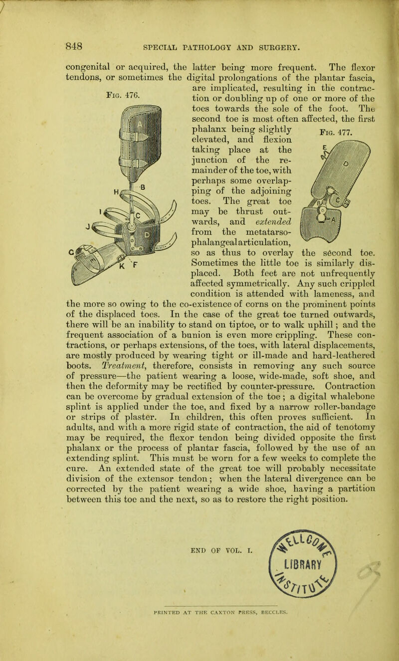 congenital or acquired, the latter being more frequent. The flexor tendons, or sometimes the digital prolongations of the plantar fascia, are implicated, resulting in the contrac- Fig. 476. ^on or doubling Up 0f one Qr more of the toes towards the sole of the foot. The second toe is most often affected, the first phalanx being slightly- elevated, and flexion taking place at the junction of the re- mainder of the toe, with perhaps some overlap- ping of the adjoining toes. The great toe may be thrust out- wards, and extended from the metatarso- phalangeal articulation, so as thus to overlay the second toe. Sometimes the little toe is similarly dis- placed. Both feet are not unfrequently affected symmetrically. Any such crippled condition is attended with lameness, and the more so owing to the co-existence of corns on the prominent points of the displaced toes. In the case of the great toe turned outwards, there will be an inability to stand on tiptoe, or to walk uphill; and the frequent association of a bunion is even more crippling. These con- tractions, or perhaps extensions, of the toes, with lateral displacements, are mostly produced by wearing tight or ill-made and hard-leathered boots. Treatment, therefore, consists in removing any such source of pressure—the patient wearing a loose, wide-made, soft shoe, and then the deformity may be rectified by counter-pressure. Contraction can be overcome by gradual extension of the toe ; a digital whalebone splint is applied under the toe, and fixed by a narrow roller-bandage or strips of plaster. In children, this often proves sufficient. In adults, and with a more rigid state of contraction, the aid of tenotomy may be required, the flexor tendon being divided opposite the first phalanx or the process of plantar fascia, followed by the use of an extending splint. This must be worn for a few weeks to complete the cure. An extended state of the great toe will probably necessitate division of the extensor tendon; when the lateral divergence can be corrected by the patient wearing a wide shoe, having a partition between this toe and the next, so as to restore the right position. END OF VOL. I.