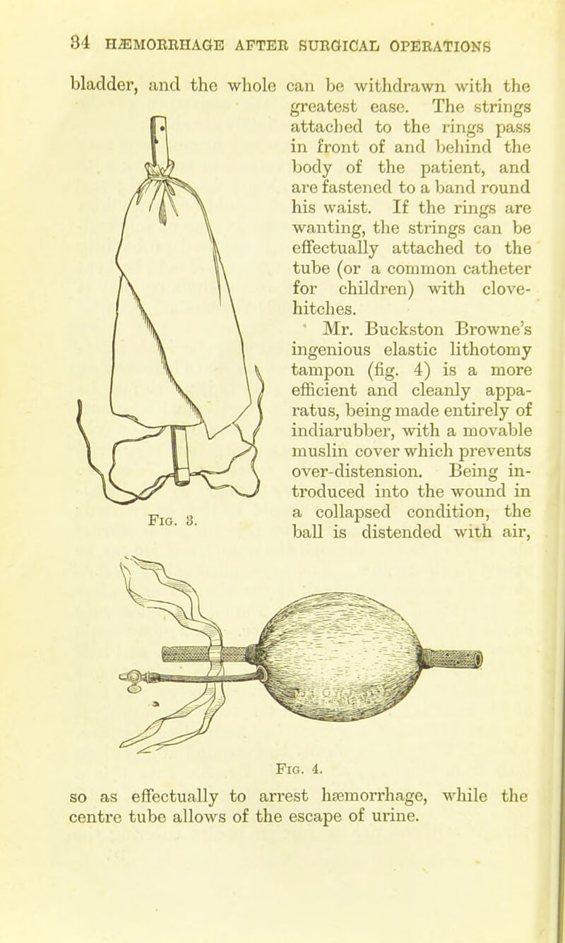 bladder, and the whole can be withdrawn with the greatest ease. The strings attaclied to the rings pass in front of and behind the body of the patient, and are fastened to a band round his waist. If the rings are wanting, the strings can be effectually attached to the tube (or a common catheter for children) with clove- hitches. Mr. Buckston Browne's ingenious elastic lithotomy tampon (fig. 4) is a more efficient and cleanly appa- ratus, being made entirely of indiarubber, with a movable muslin cover which prevents over-distension. Being in- troduced into the wound in a collapsed condition, the ball is distended with air, Fig. Pig. 4. so as effectually to arrest hfemorrhage, while the centre tube allows of the escape of urine.