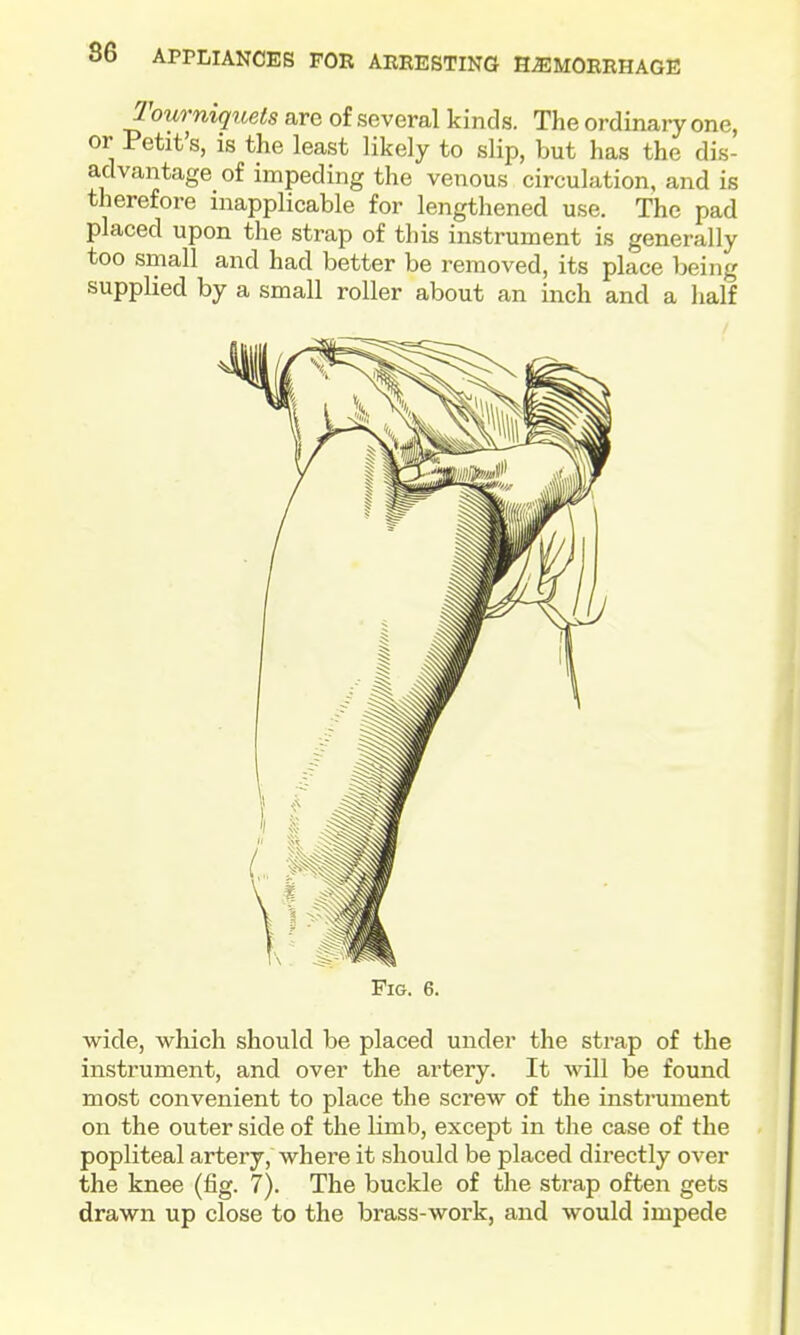 Tourniquets are of several kinds. The ordinary one, or Petit's, is the least likely to slip, but has the dis- advantage of impeding the venous circulation, and is therefore inapplicable for lengthened use. The pad placed upon the strap of this instrument is generally too small and had better be removed, its place being supplied by a small roller about an inch and a half Fig. 6. wide, which should be placed under the strap of the instrument, and over the artery. It will be found most convenient to place the screw of the instrument on the outer side of the limb, except in the case of the popliteal artery, where it should be placed directly over the knee (fig. 7). The buckle of the strap often gets drawn up close to the brass-work, and would impede