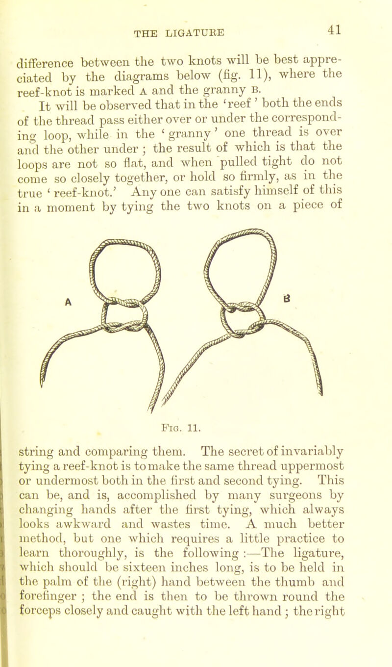 difference between the two knots will be best appre- ciated by the diagrams below (fig. 11), where the reef-knot is marked A and the granny B. It will be observed that in the 'reef ' both the ends of the thread pass either over or under the correspond- ing loop, while in the ' granny' one thread is over and the other under ; the result of which is that the loops are not so flat, and when pulled tight do not come so closely together, or hold so firmly, as in the true ' reef-knot.' Any one can satisfy himself of this in a moment by tying the two knots on a piece of Fig. 11. string and comparing them. The secret of invariably tying a reef-knot is to make the same thread uppermost or undermost both in the first and second tying. This can be, and is, accomplished by many sui'geons by changing hands after the first tying, which always looks awkward and wastes time. A much better method, but one which requires a little practice to learn thoroughly, is the following :—The ligature, which should be sixteen inches long, is to be held in the palm of tlie (right) hand between the thumb and forelinger ; the end is tlien to be thrown round the forceps closely and caught with the left hand; the right